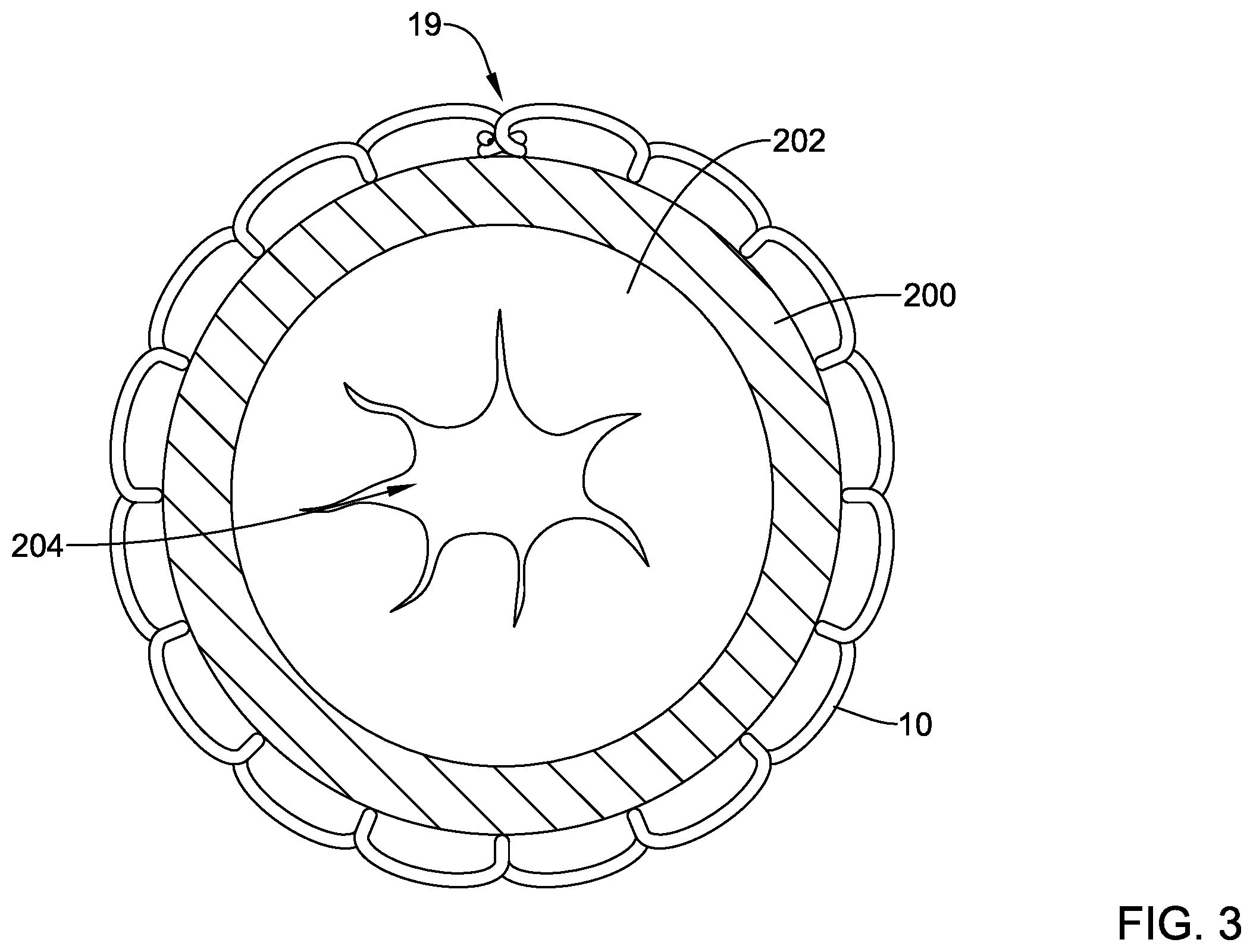 Patent US12569325 Figure 3 – Device for use with body tissue sphincters