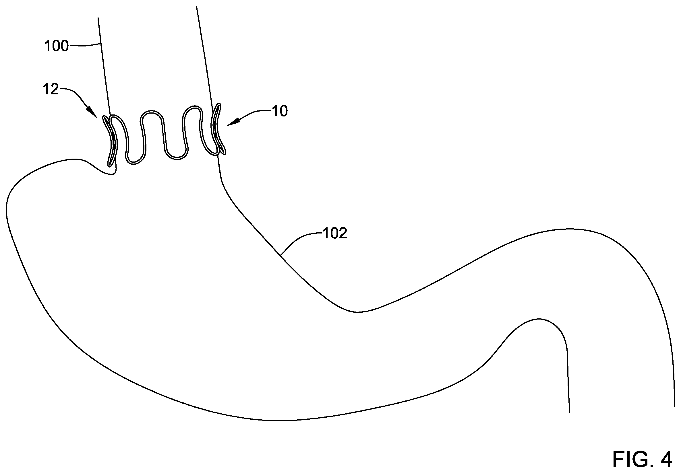 Patent US12569325 Figure 4 – Device for use with body tissue sphincters
