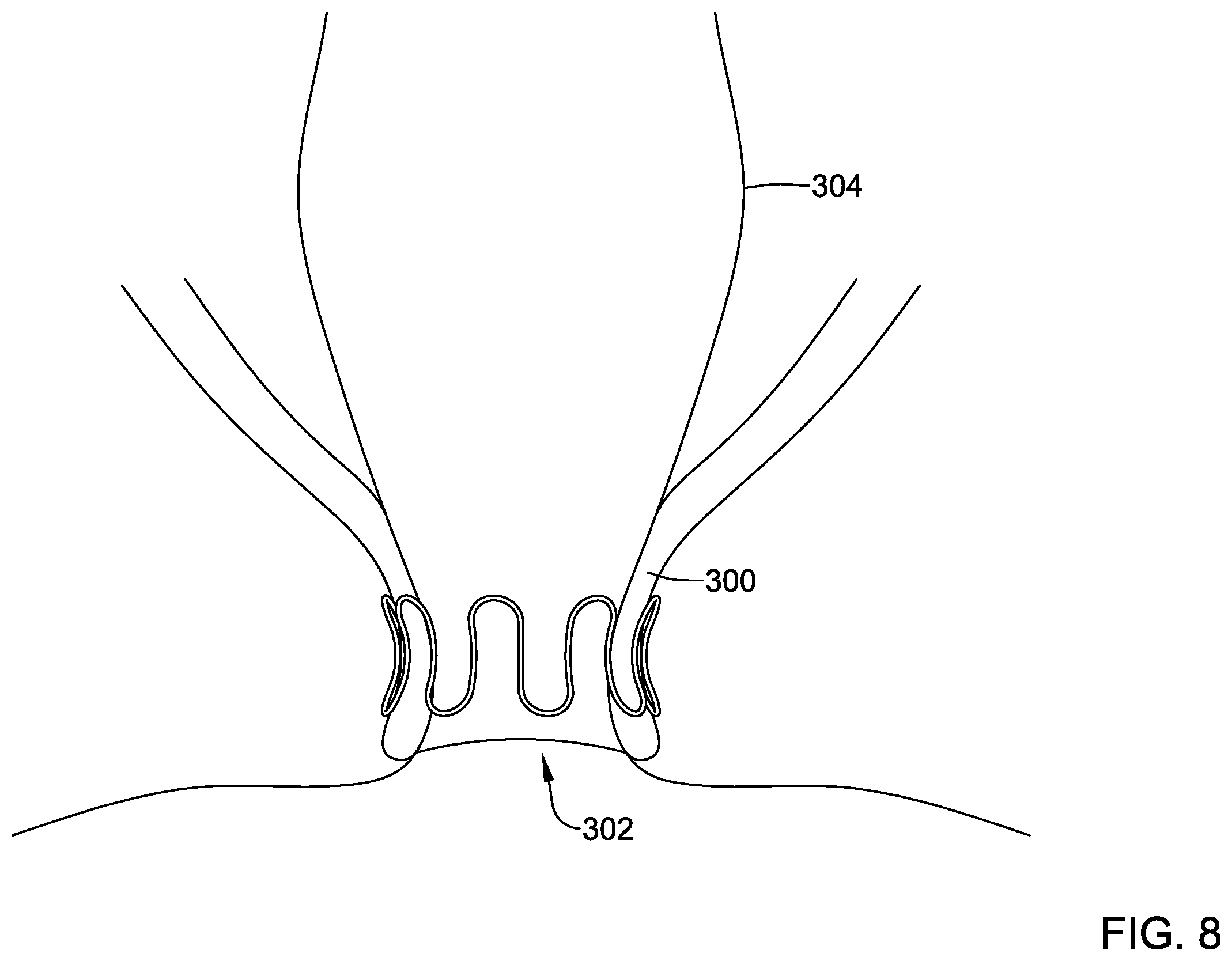 Patent US12569325 Figure 8 – Device for use with body tissue sphincters