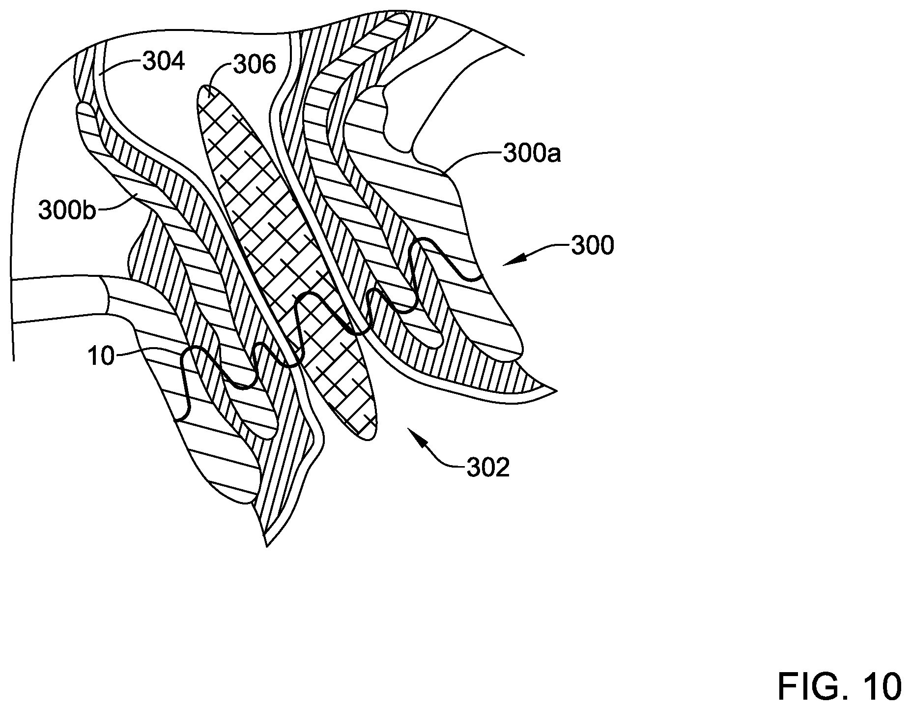 Patent US12569325 Figure 10 – Device for use with body tissue sphincters