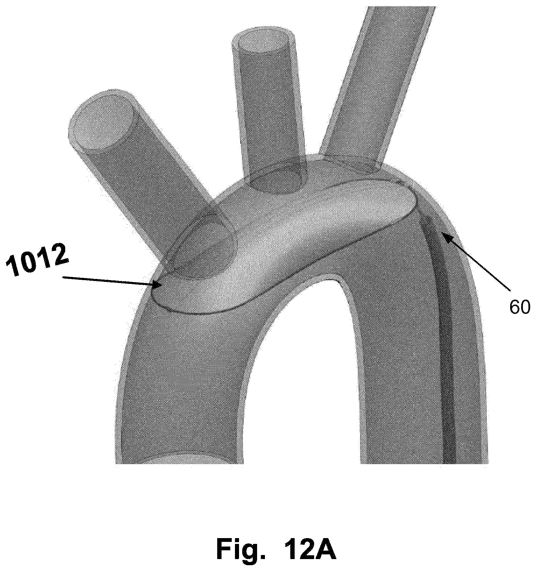 Patent US12569328 Figure 12 – Device for filtering embolic material in a vascular system