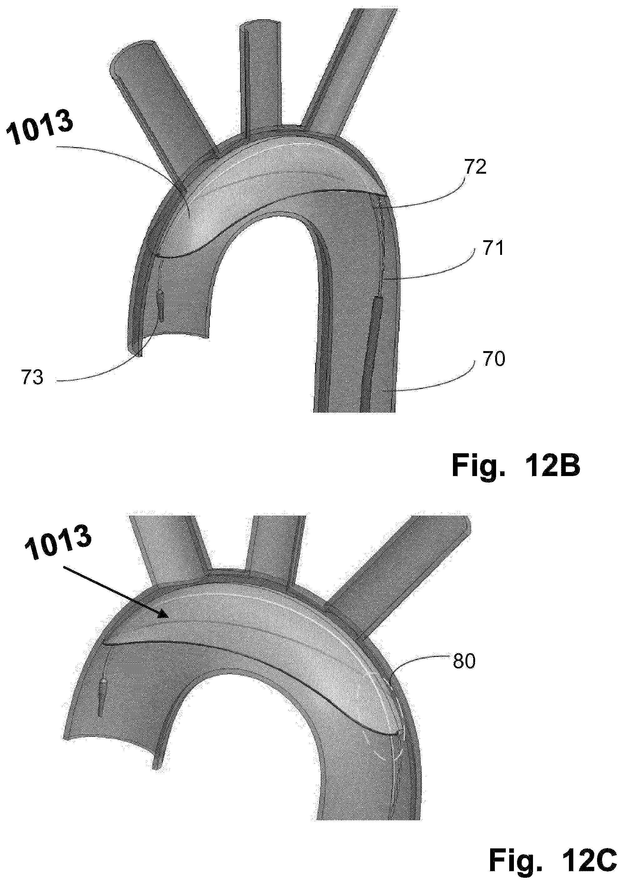 Patent US12569328 Figure 13 – Device for filtering embolic material in a vascular system