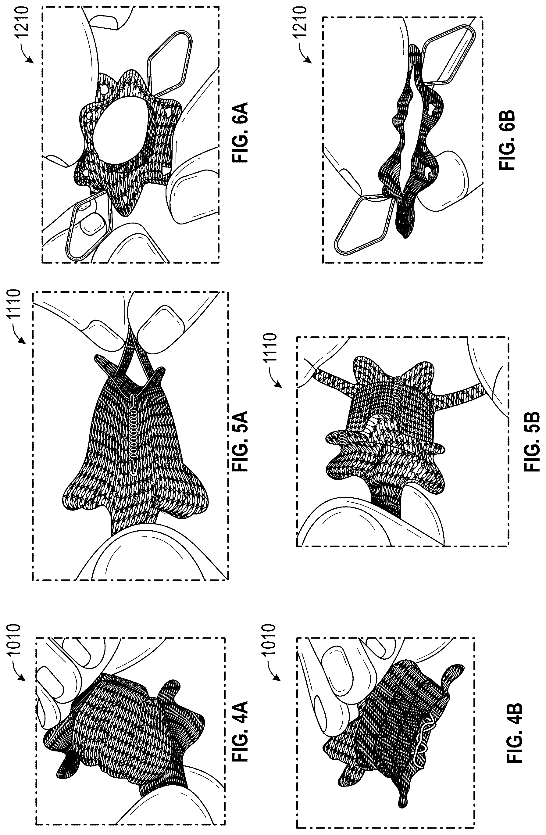Patent US12569330 Figure 7 – Percutaneous Potts shunt devices and related methods