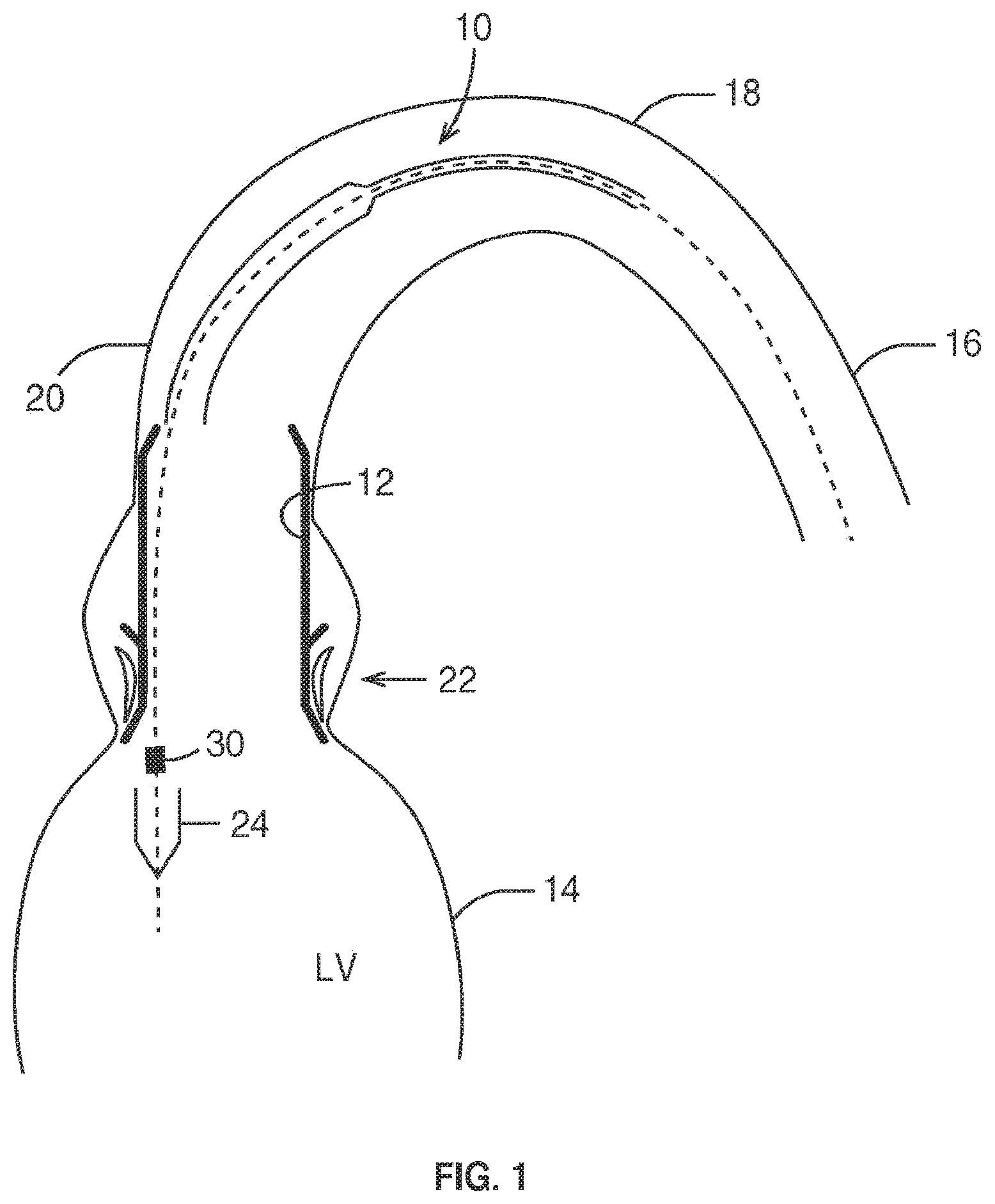 Patent US12569337 Figure 1 – Prosthetic valve, delivery apparatus and delivery method