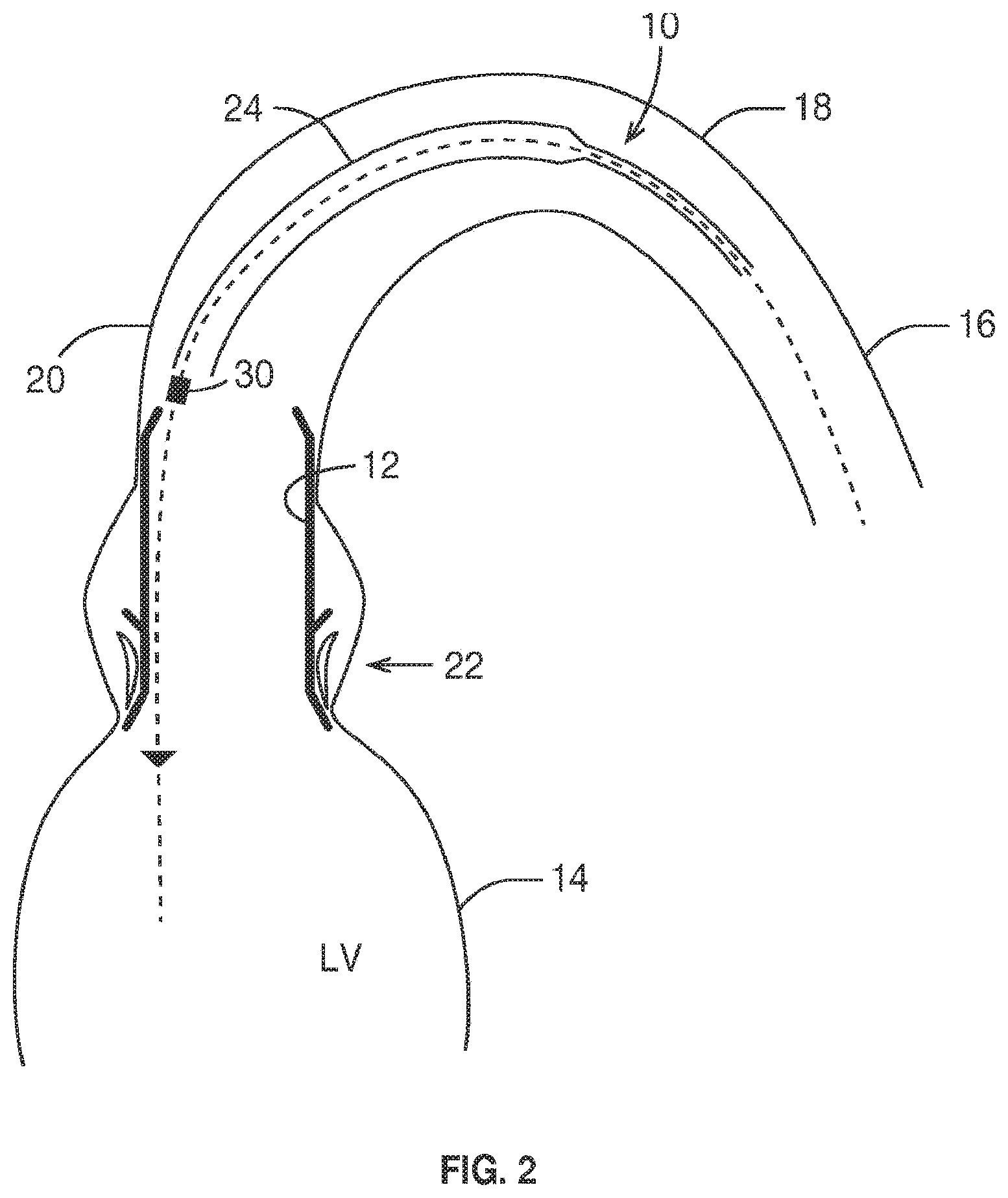 Patent US12569337 Figure 2 – Prosthetic valve, delivery apparatus and delivery method