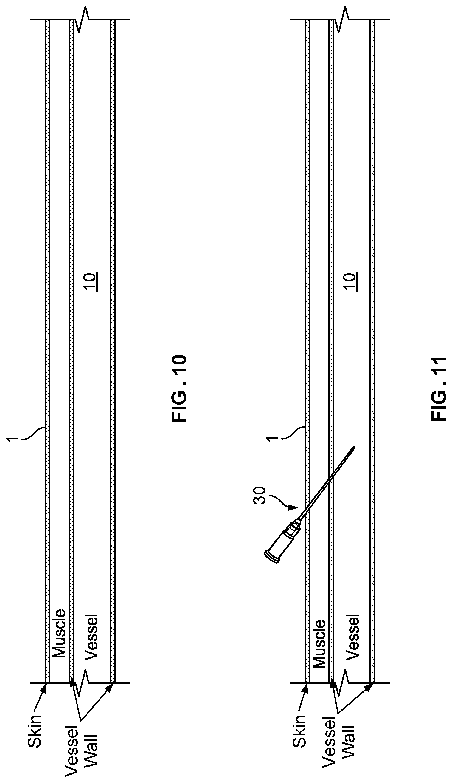 Patent US12569338 Figure 5 – Dilating introducer devices and methods for vascular access