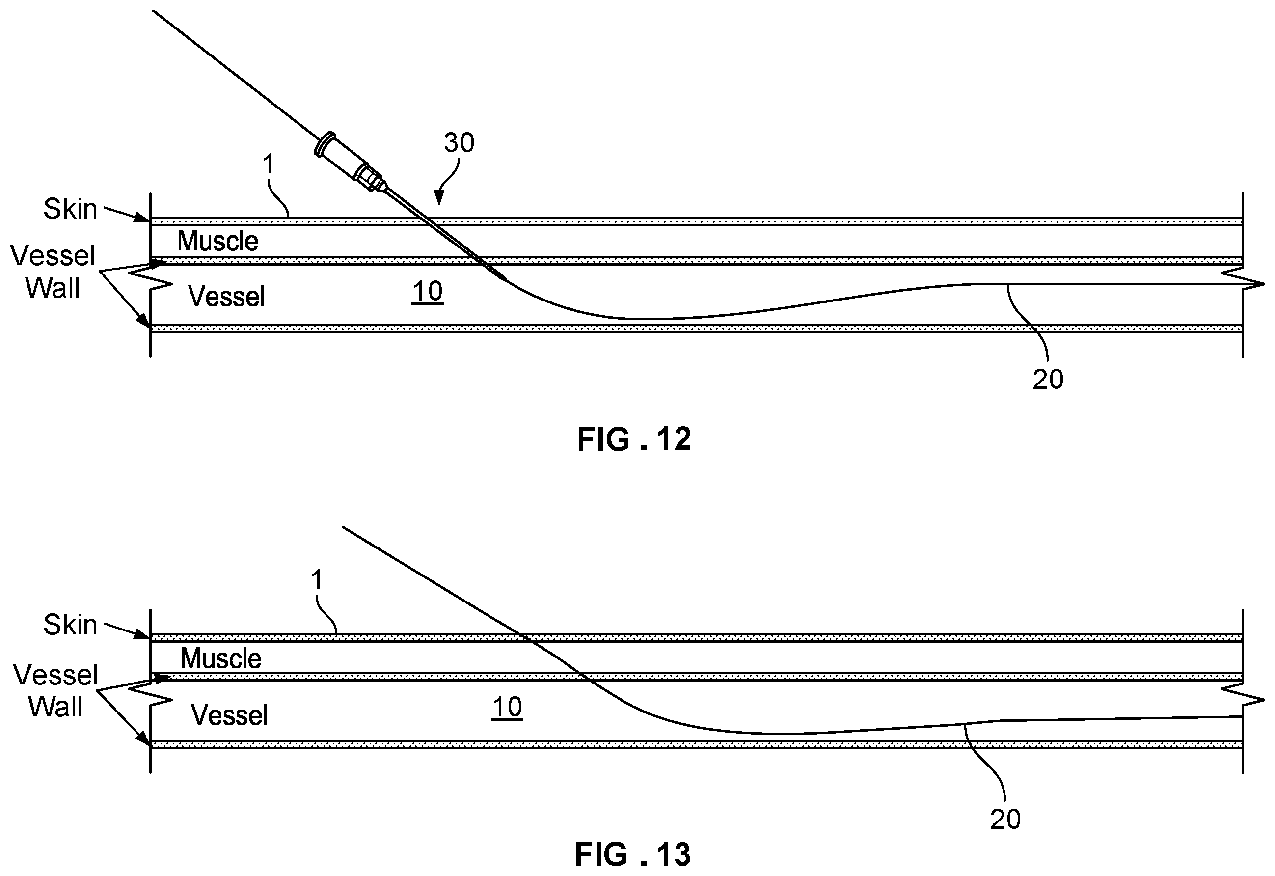 Patent US12569338 Figure 6 – Dilating introducer devices and methods for vascular access