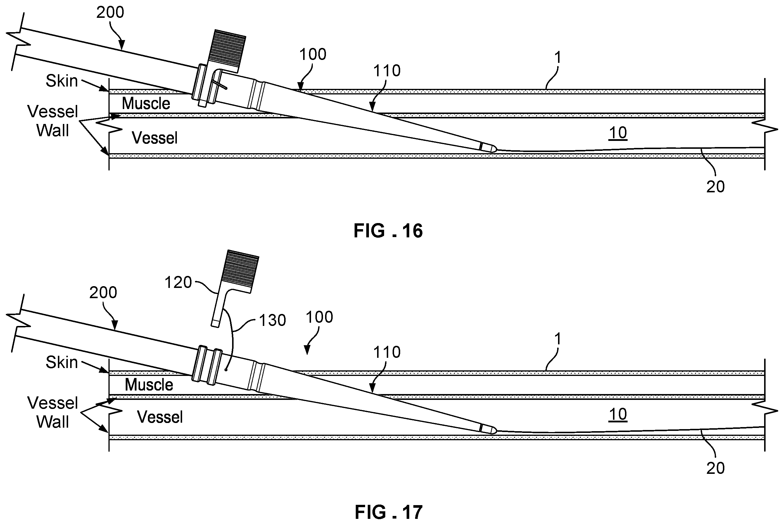 Patent US12569338 Figure 8 – Dilating introducer devices and methods for vascular access