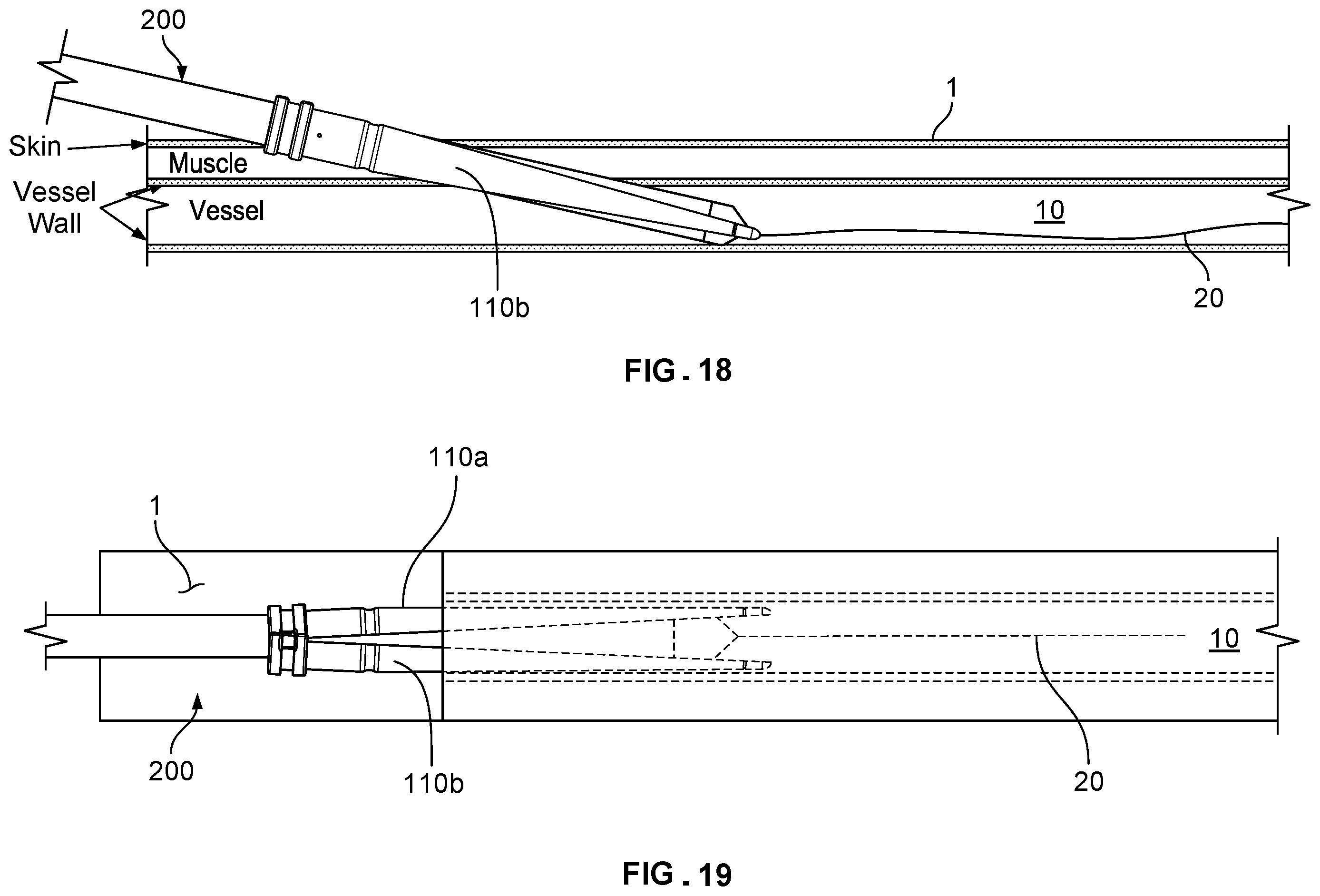 Patent US12569338 Figure 9 – Dilating introducer devices and methods for vascular access