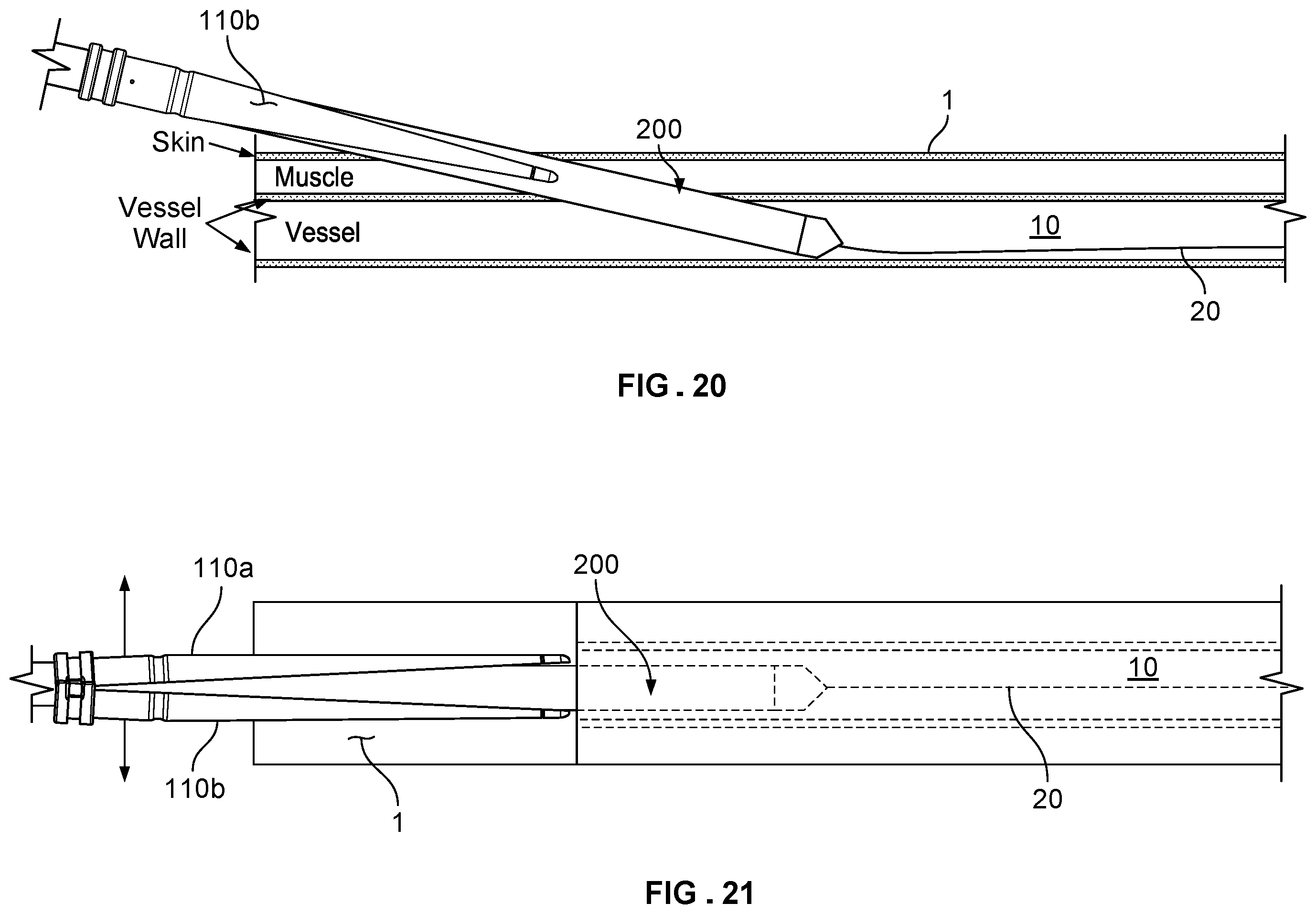 Patent US12569338 Figure 10 – Dilating introducer devices and methods for vascular access