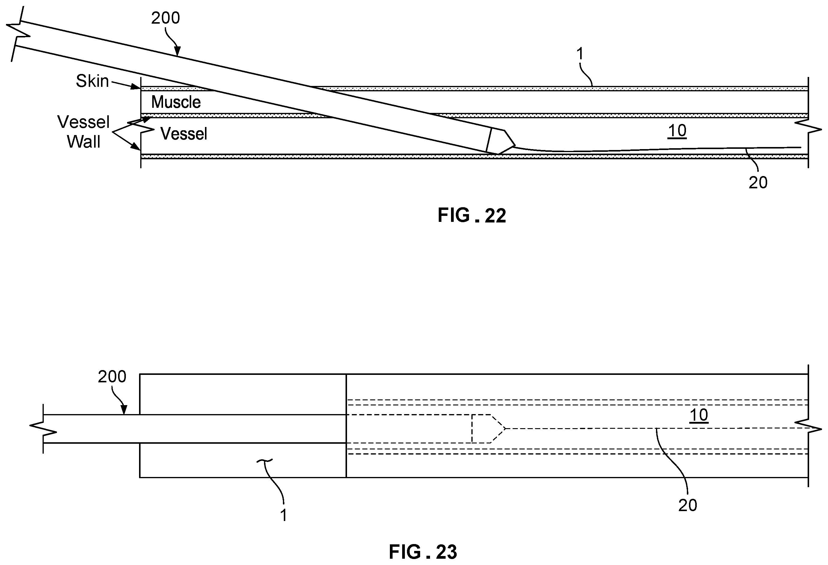 Patent US12569338 Figure 11 – Dilating introducer devices and methods for vascular access