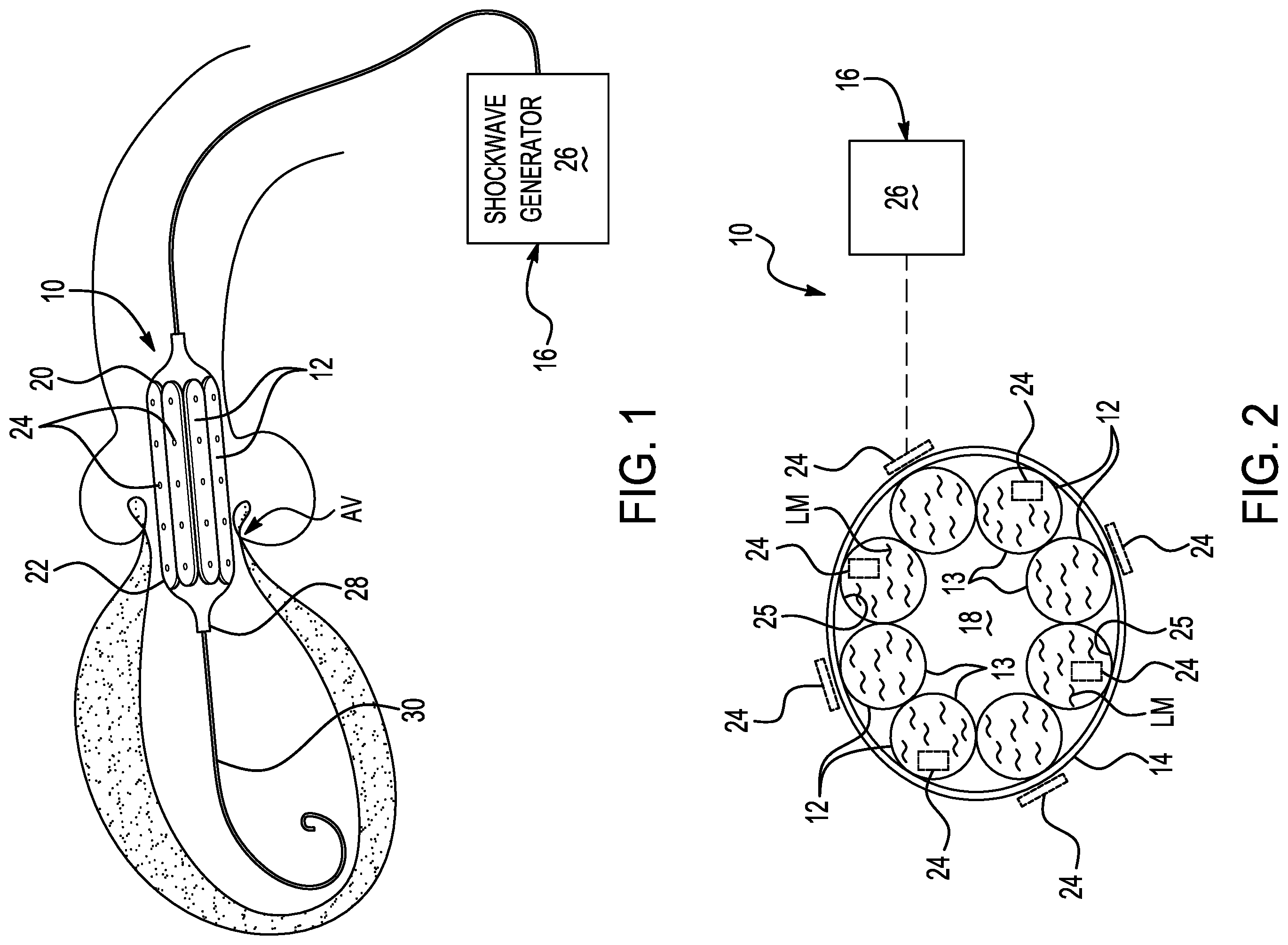 Patent US12569339 Figure 1 – Aortic valve lithotripsy balloon