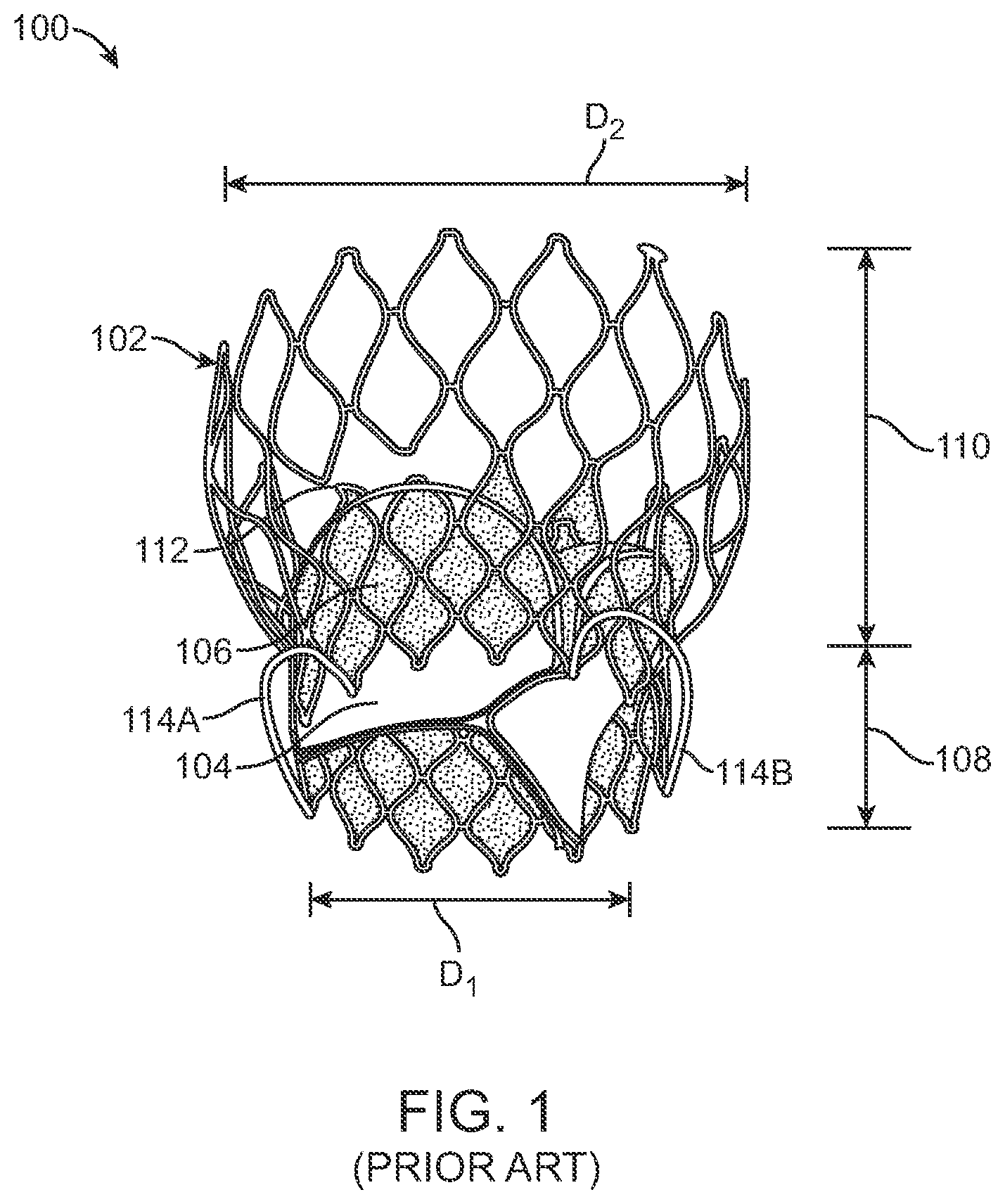 Patent US12569340 Figure 1 – Transcatheter valve prosthesis and a concurrently delivered sealing component
