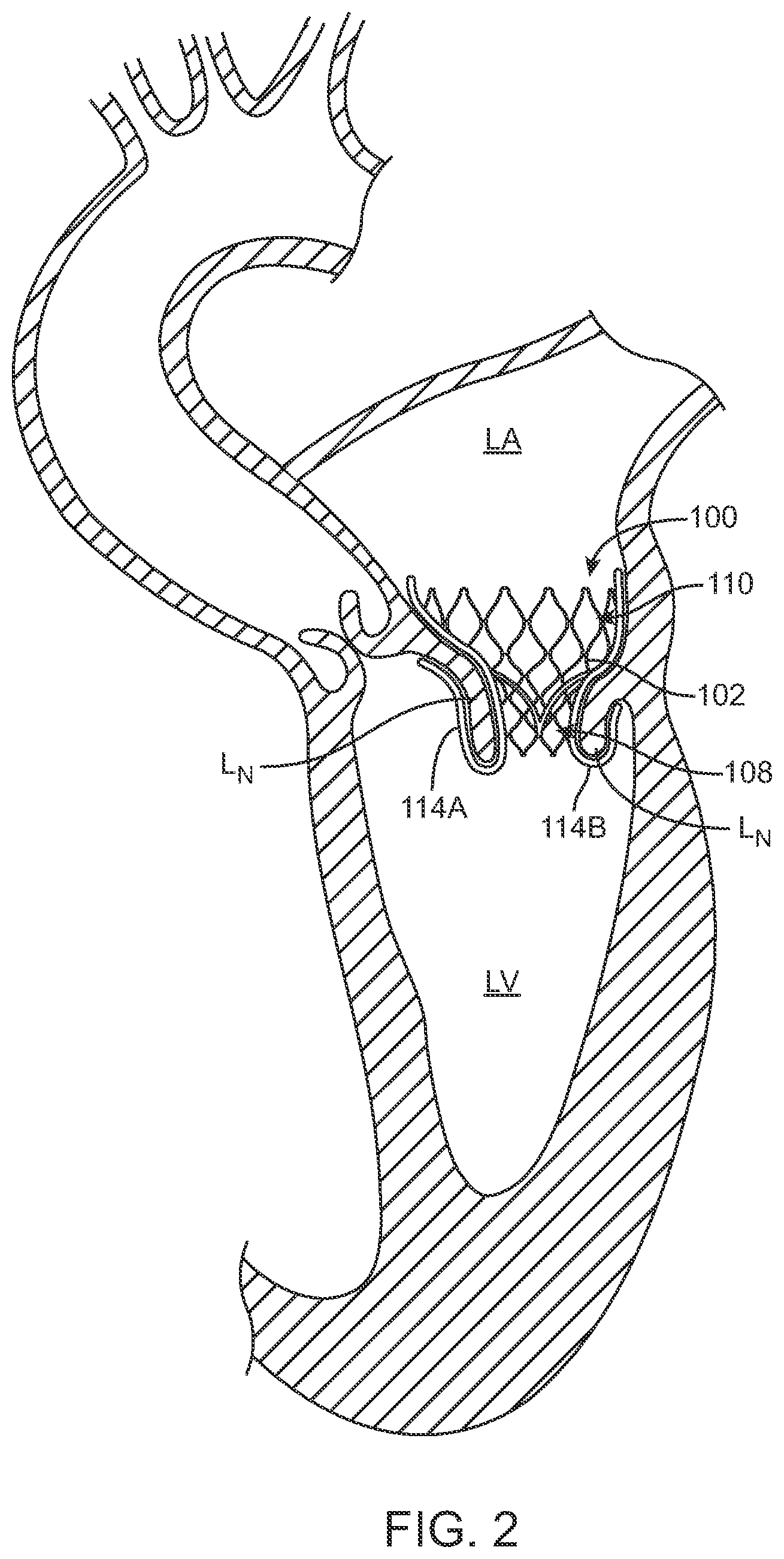 Patent US12569340 Figure 2 – Transcatheter valve prosthesis and a concurrently delivered sealing component