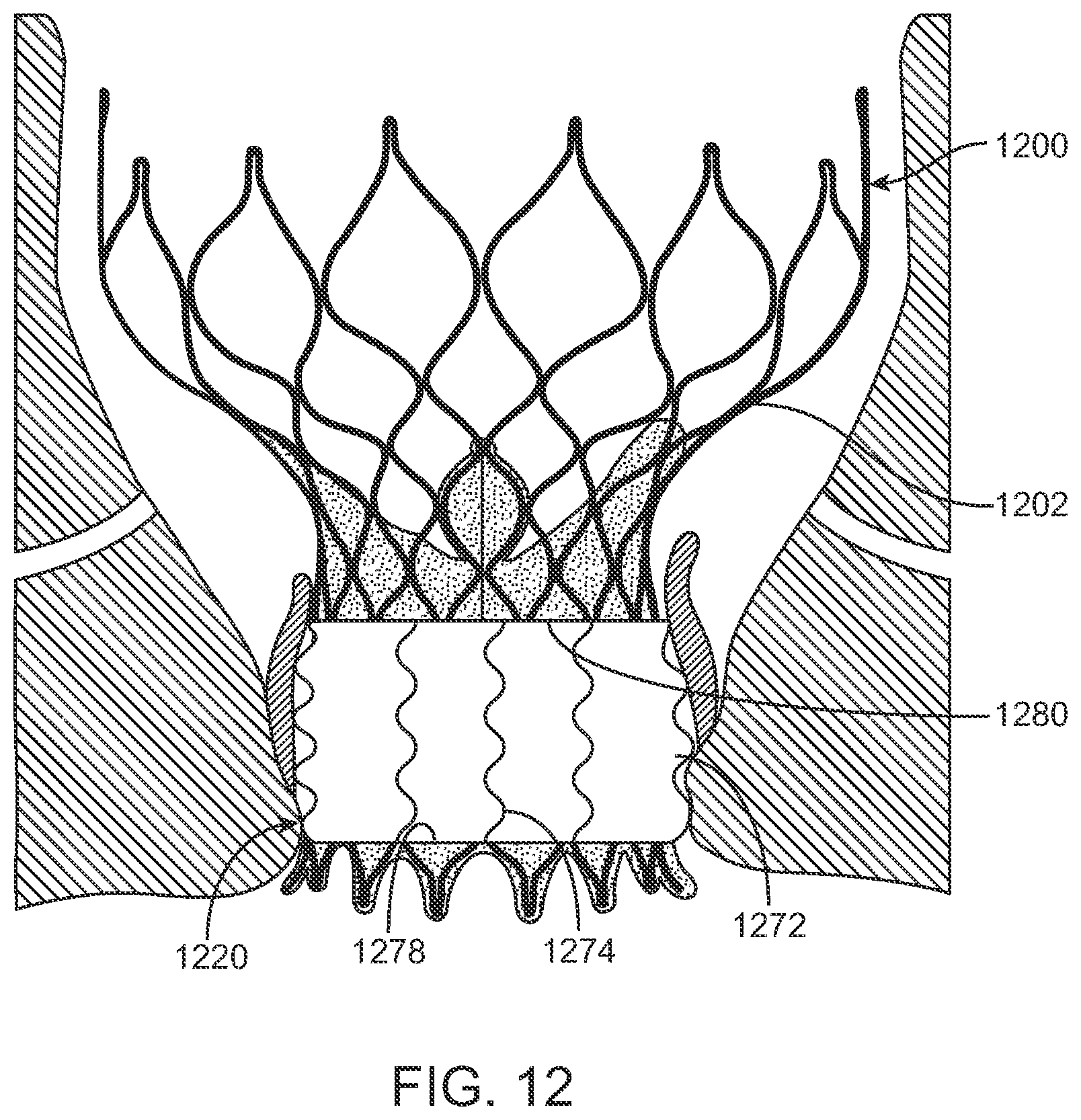 Patent US12569340 Figure 7 – Transcatheter valve prosthesis and a concurrently delivered sealing component