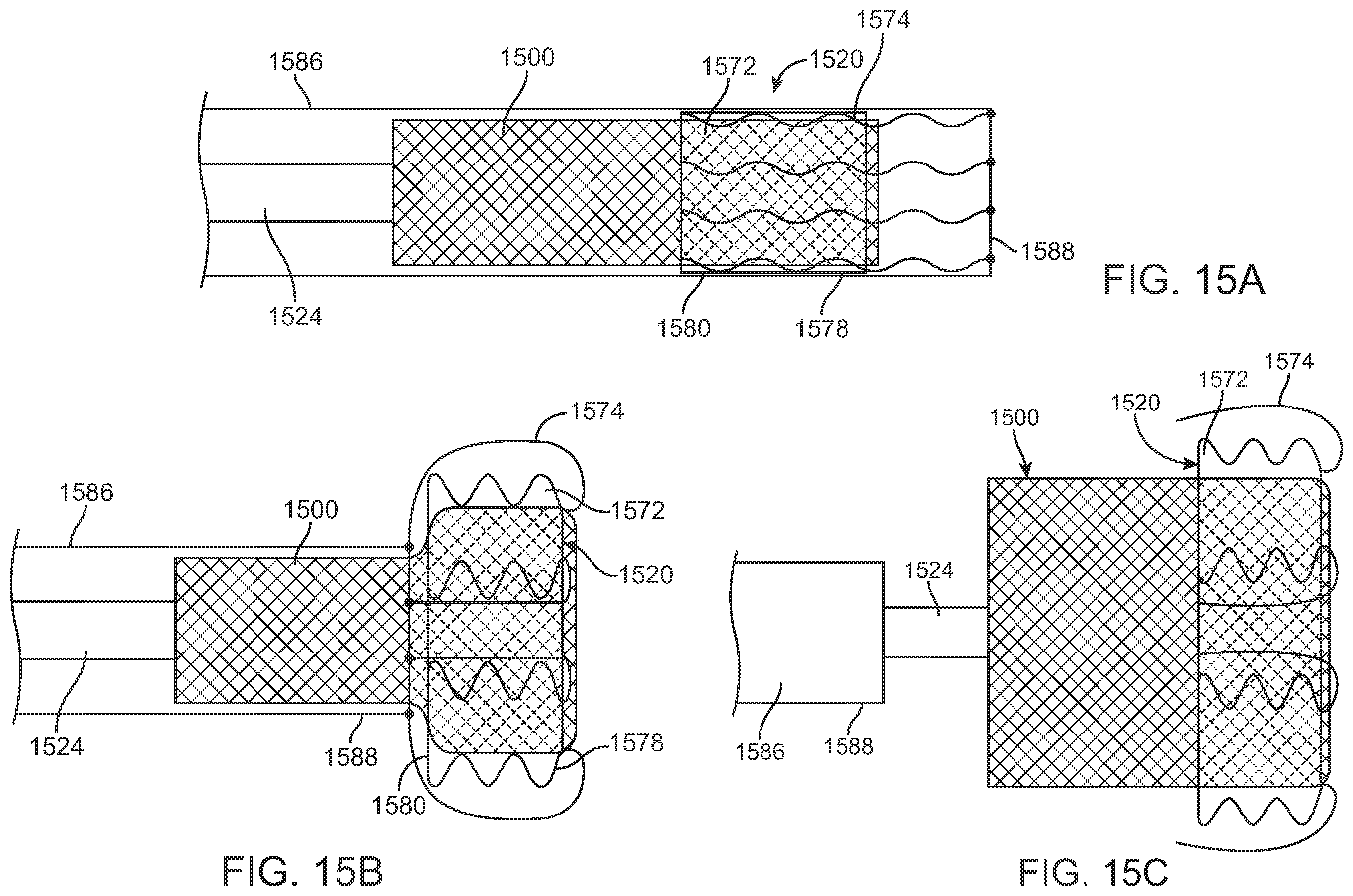 Patent US12569340 Figure 9 – Transcatheter valve prosthesis and a concurrently delivered sealing component