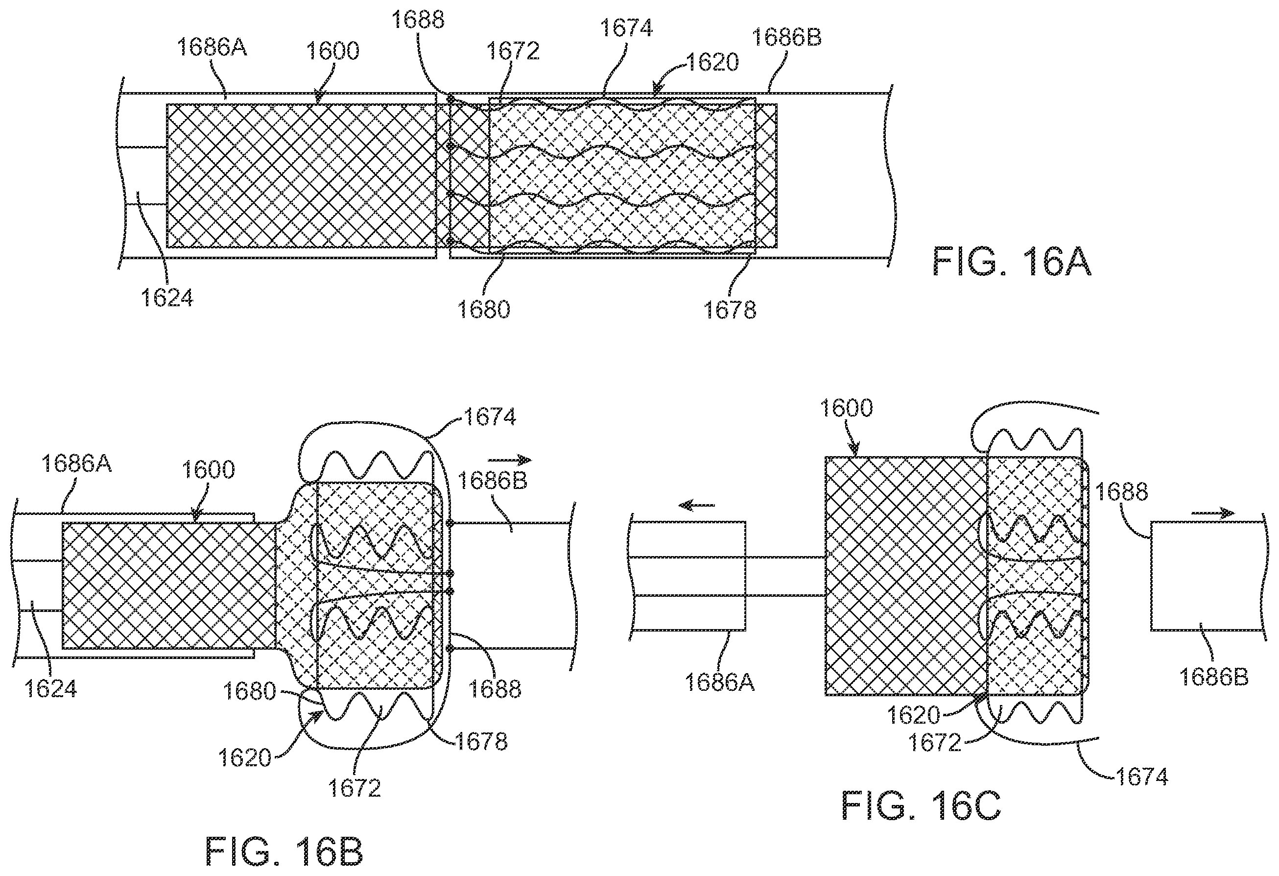 Patent US12569340 Figure 10 – Transcatheter valve prosthesis and a concurrently delivered sealing component