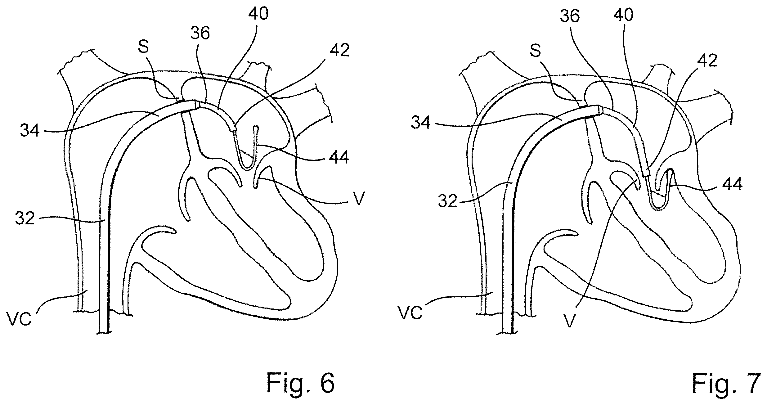 Patent US12569341 Figure 3 – Device for arranging guidewires around a heart valve