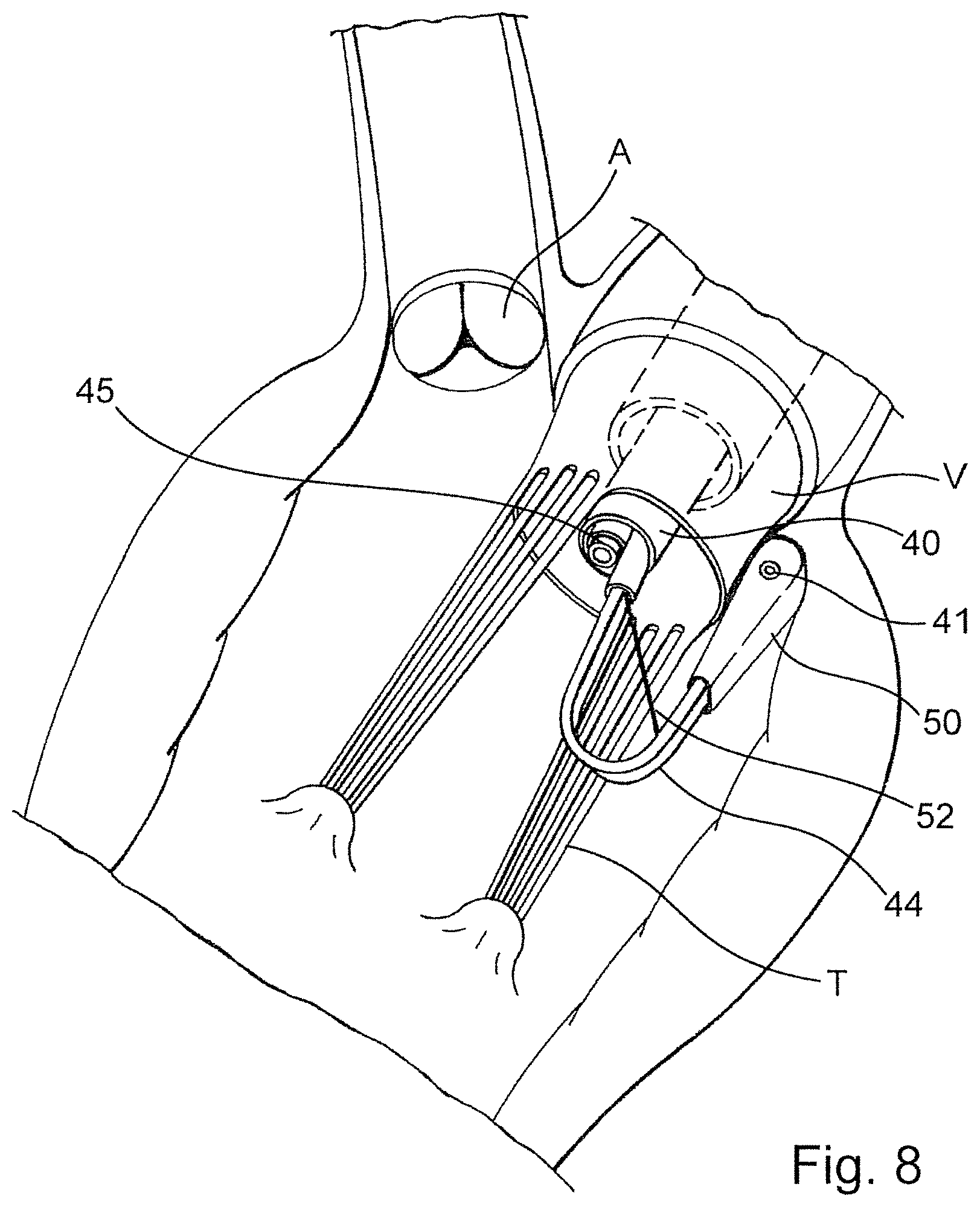 Patent US12569341 Figure 4 – Device for arranging guidewires around a heart valve