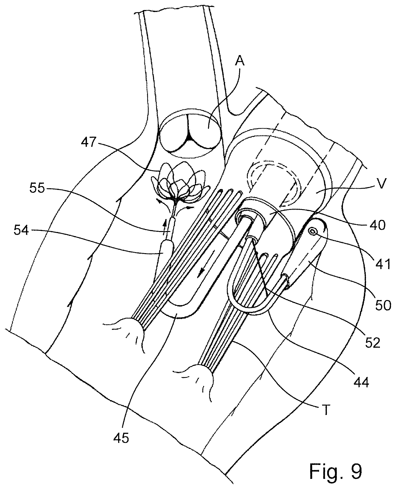 Patent US12569341 Figure 5 – Device for arranging guidewires around a heart valve
