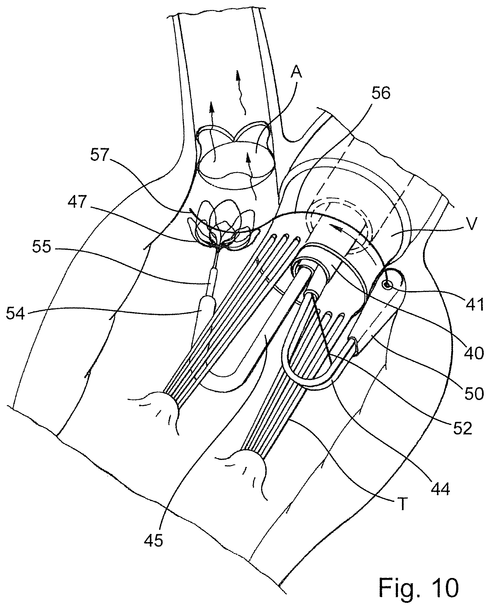 Patent US12569341 Figure 6 – Device for arranging guidewires around a heart valve