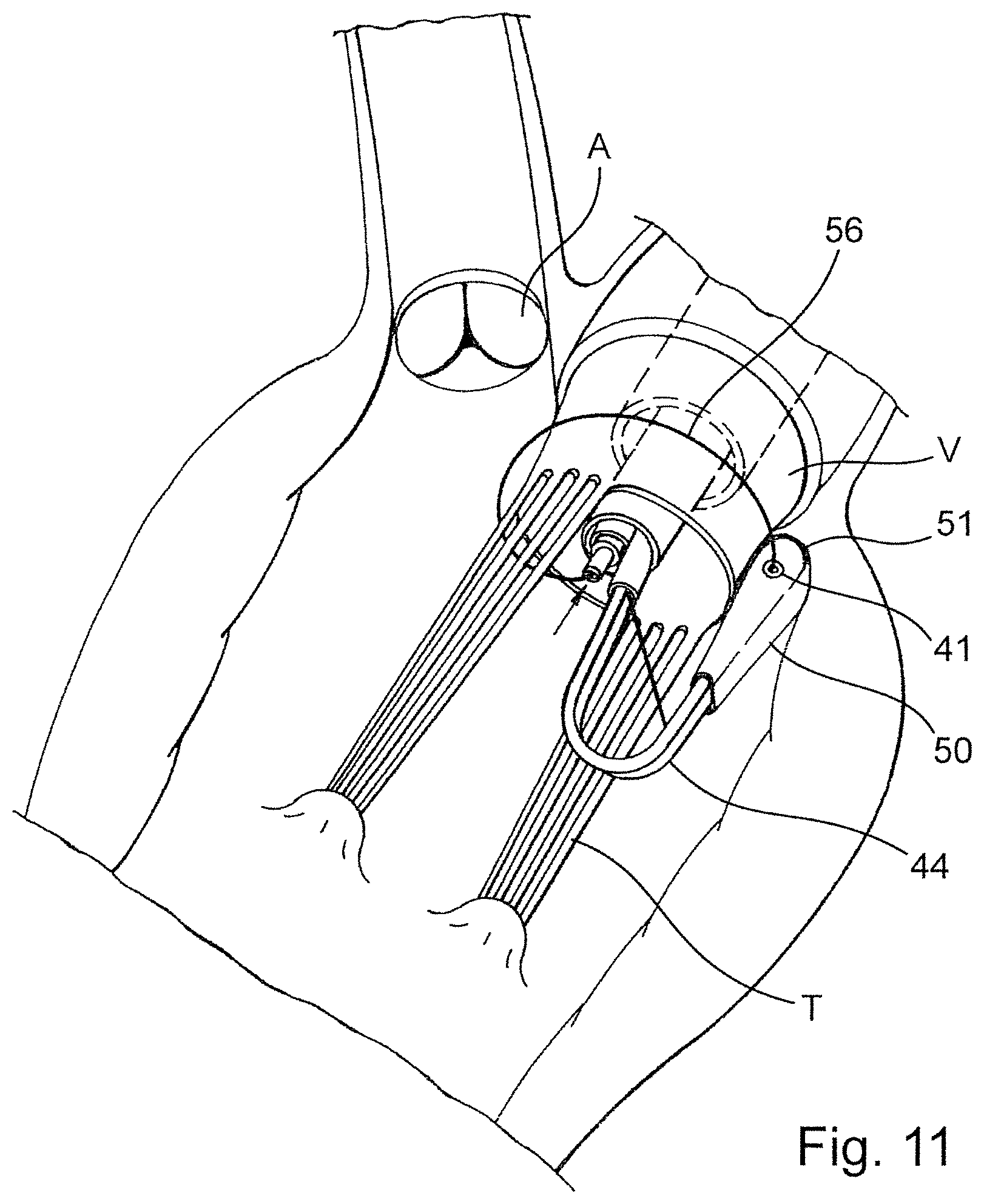 Patent US12569341 Figure 7 – Device for arranging guidewires around a heart valve