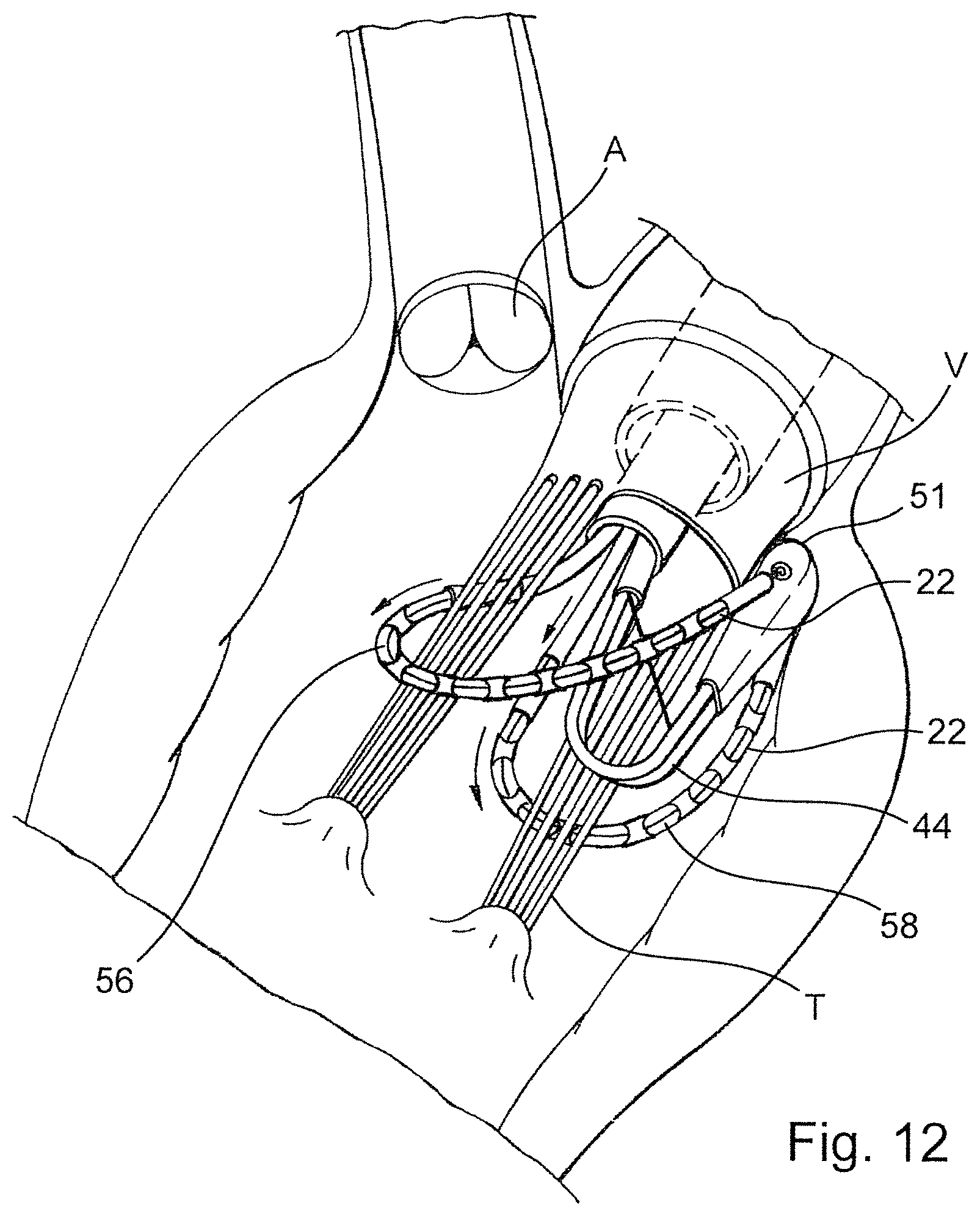 Patent US12569341 Figure 8 – Device for arranging guidewires around a heart valve