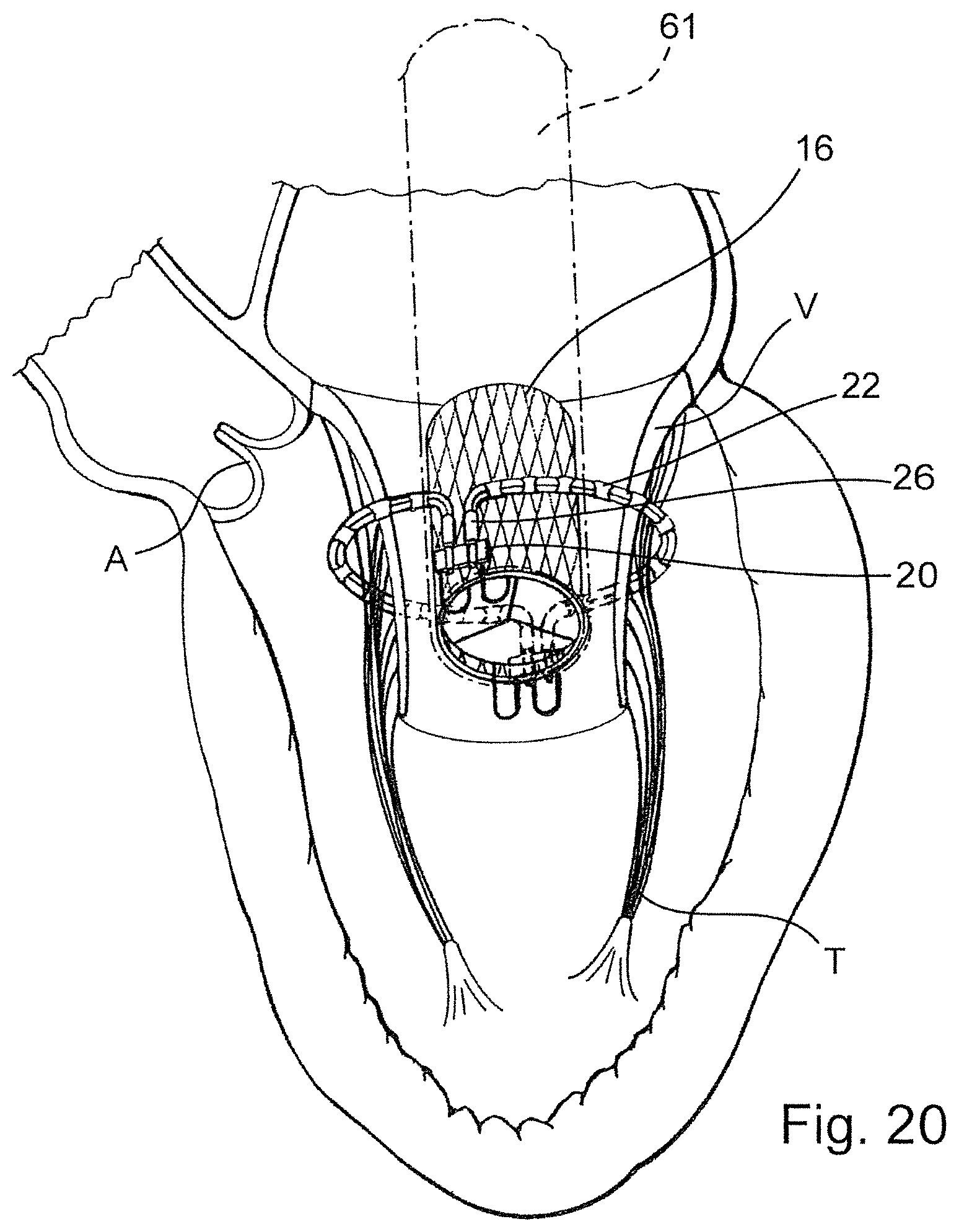 Patent US12569341 Figure 12 – Device for arranging guidewires around a heart valve