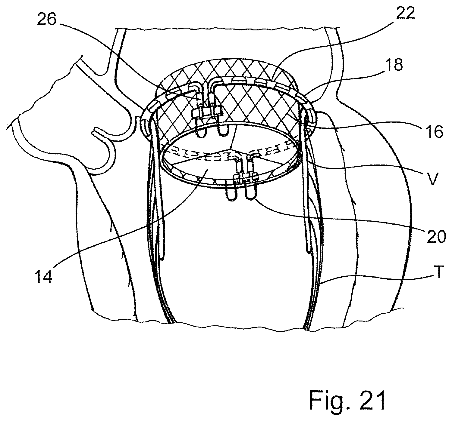Patent US12569341 Figure 13 – Device for arranging guidewires around a heart valve