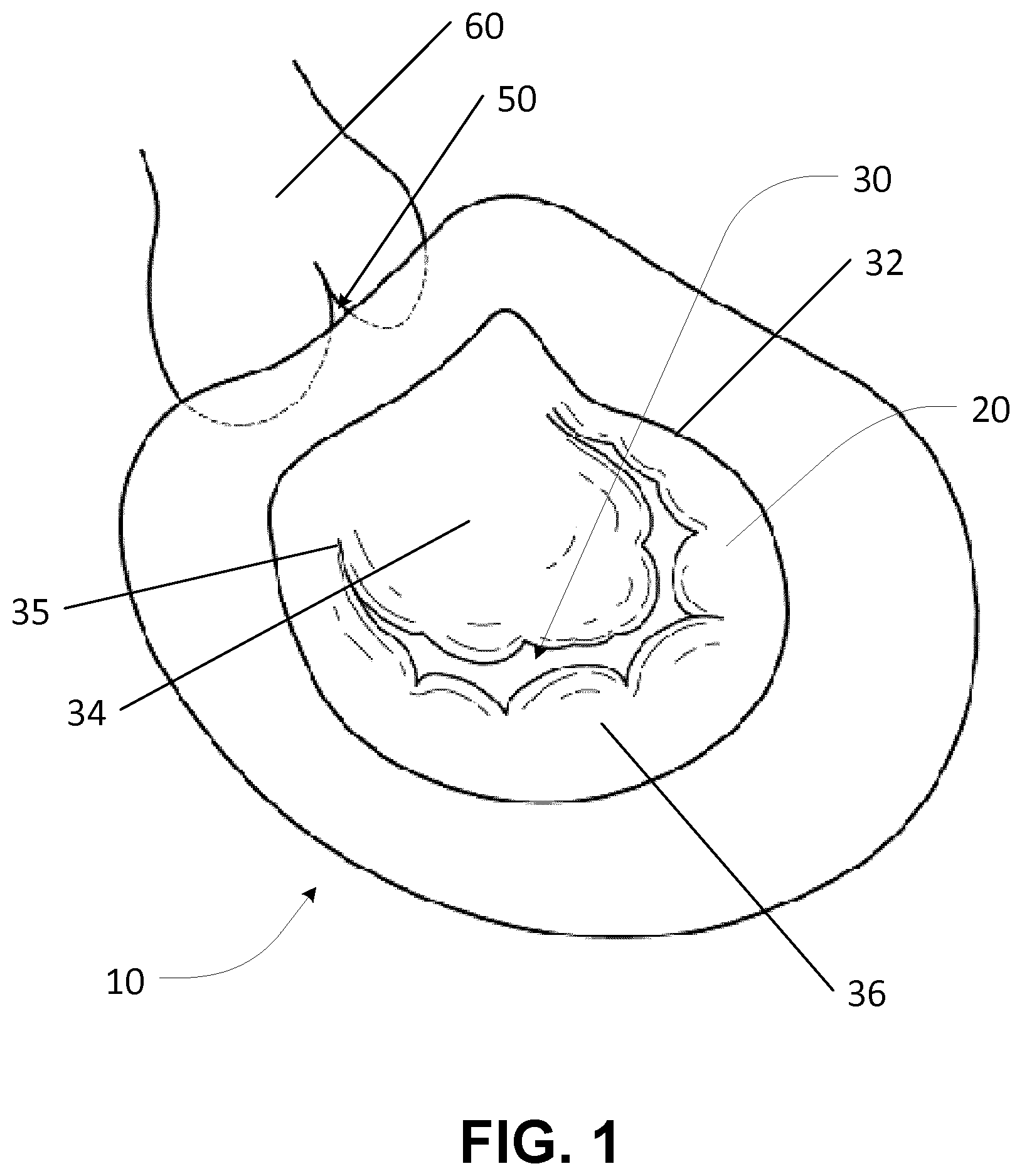 Patent US12569342 Figure 1 – Apparatus and methods for clamping a mitral valve