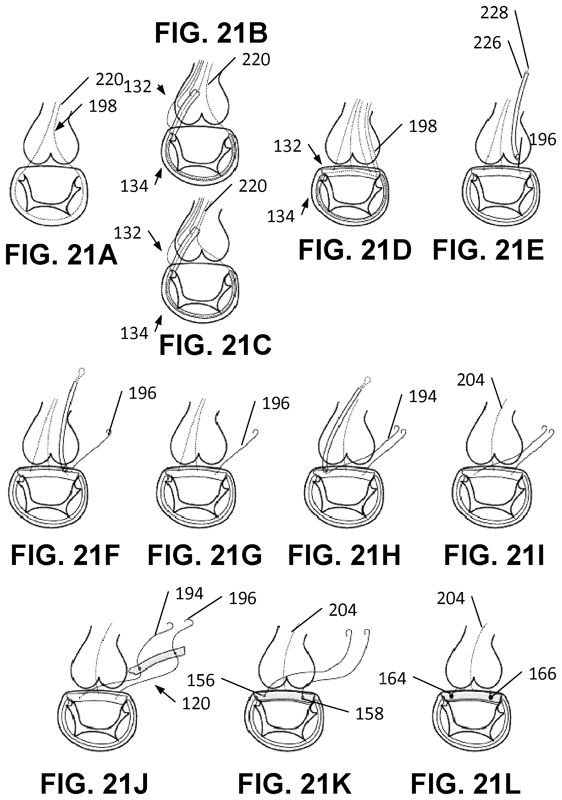 Patent US12569342 Figure 18 – Apparatus and methods for clamping a mitral valve
