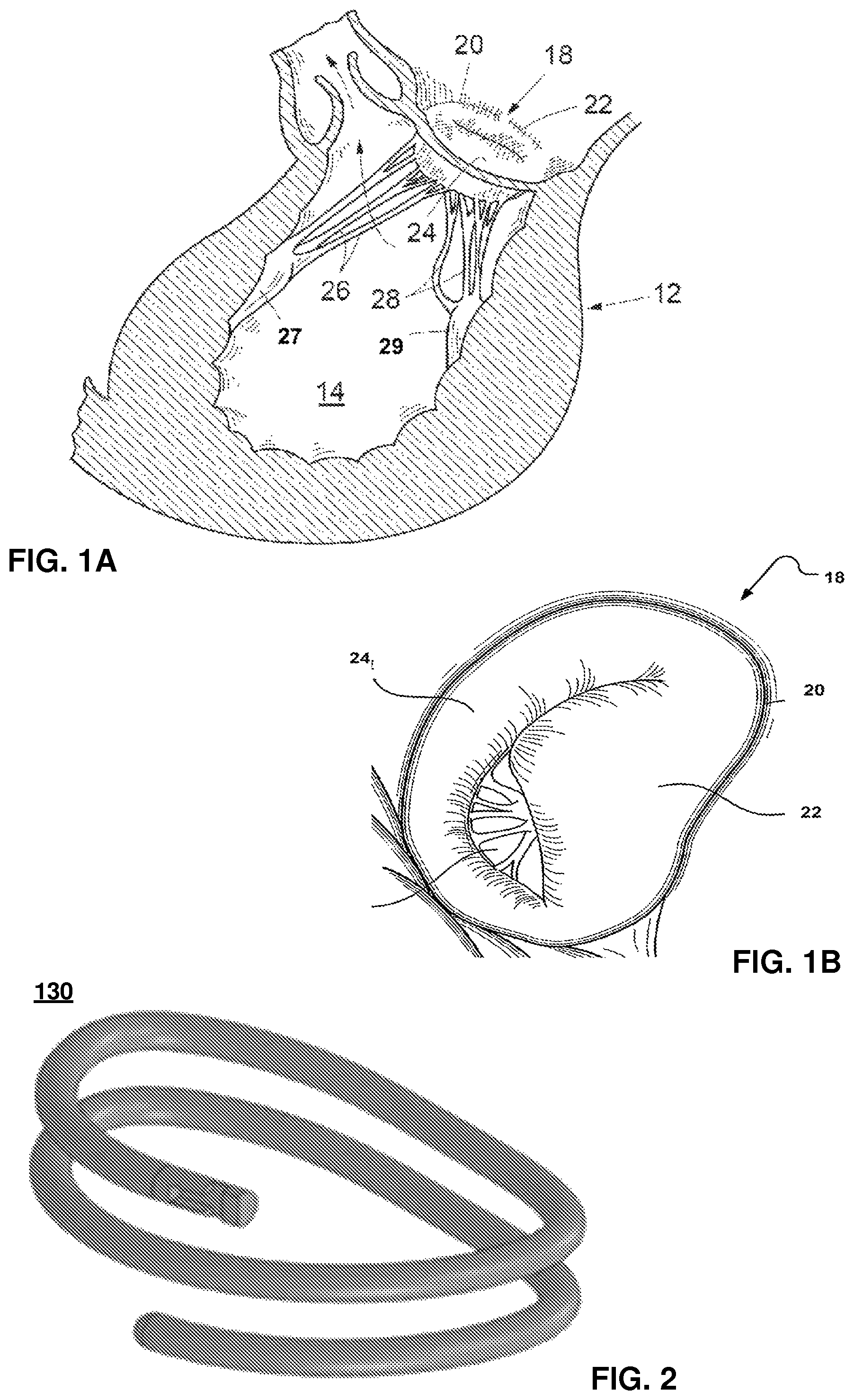 Patent US12569343 Figure 1 – Catheter for manipulating anatomical structure and relative position of the catheter and the anatomical structure