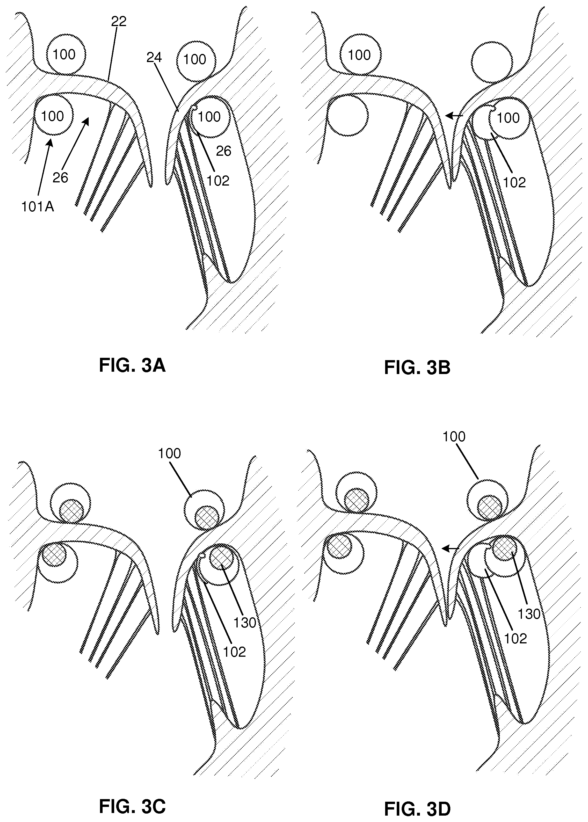 Patent US12569343 Figure 2 – Catheter for manipulating anatomical structure and relative position of the catheter and the anatomical structure