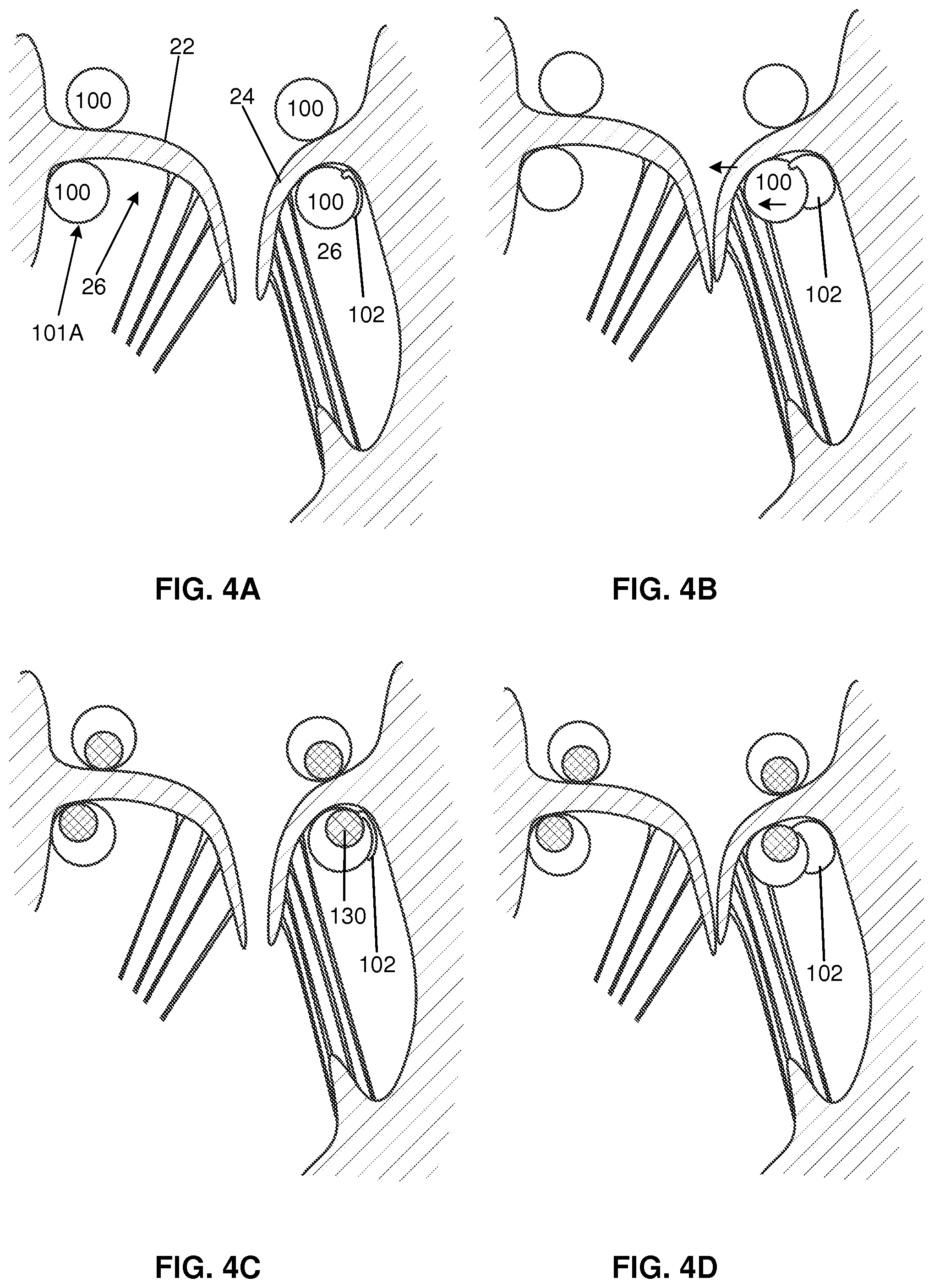 Patent US12569343 Figure 3 – Catheter for manipulating anatomical structure and relative position of the catheter and the anatomical structure