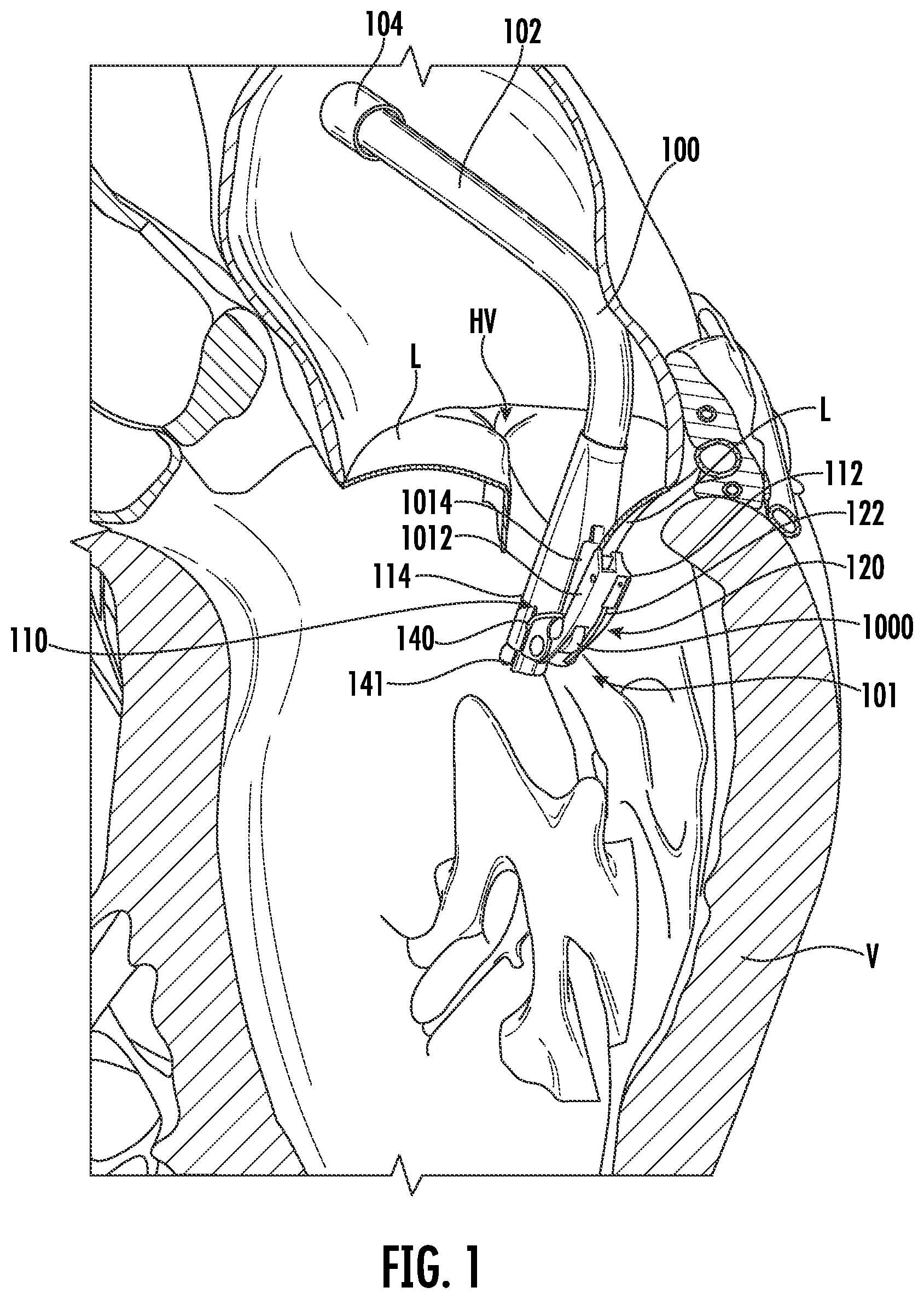 Patent US12569344 Figure 1 – Devices, systems, and methods for clamping a leaflet of a heart valve