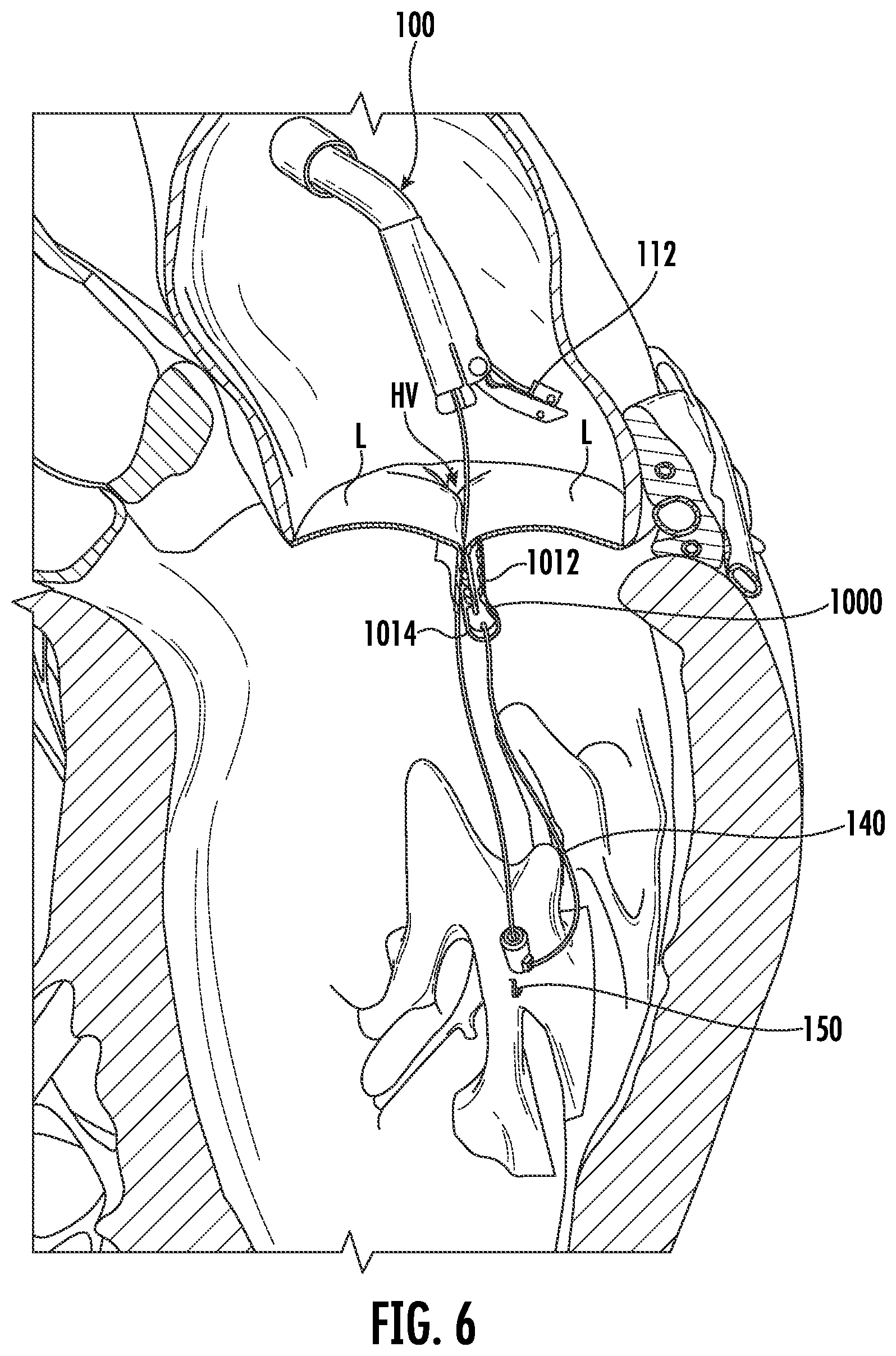 Patent US12569344 Figure 6 – Devices, systems, and methods for clamping a leaflet of a heart valve