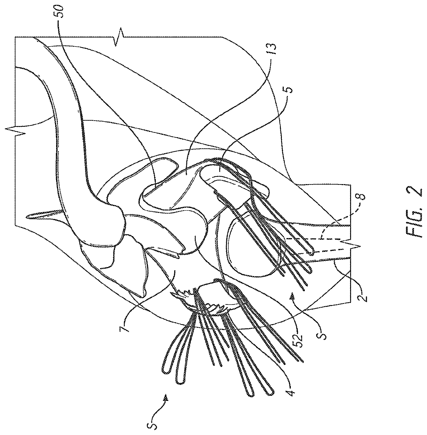 Patent US12569346 Figure 2 – Patient-specific bone fracture prostheses and methods of making the same
