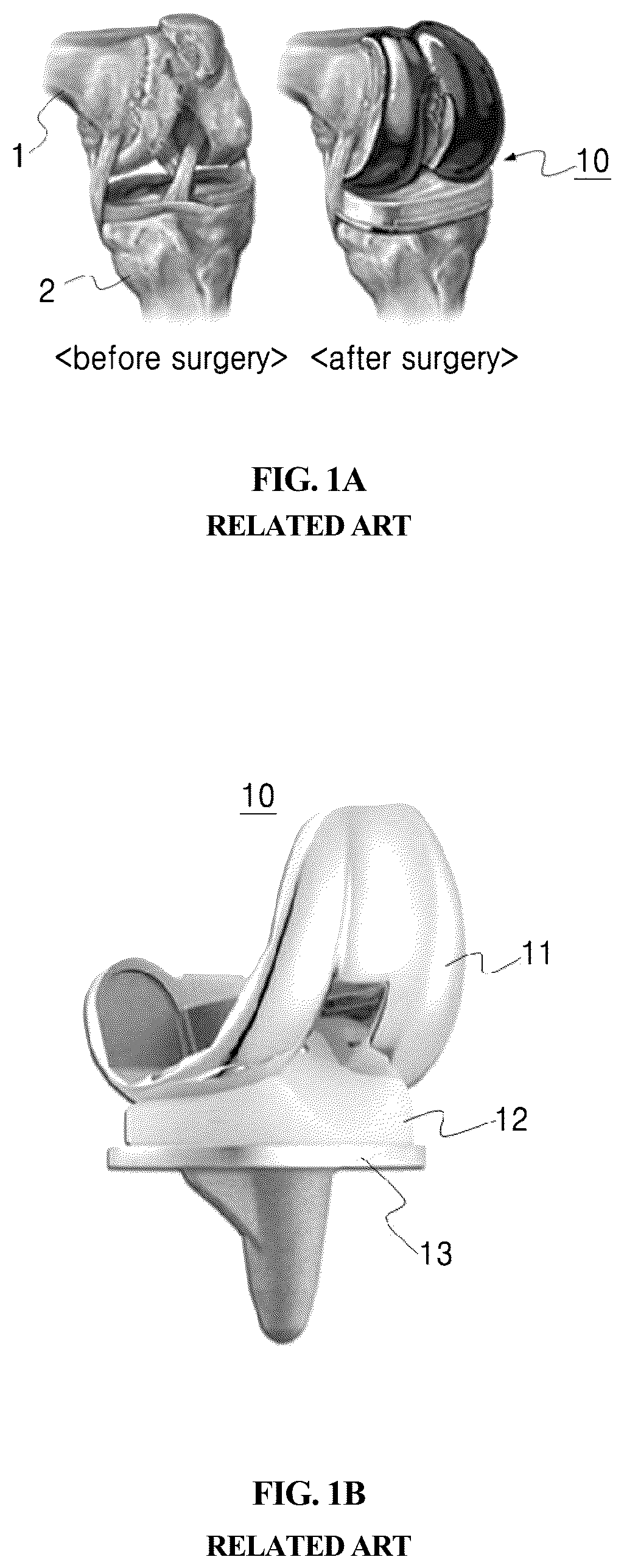 Patent US12569348 Figure 1 – Bearing component for artificial knee joint