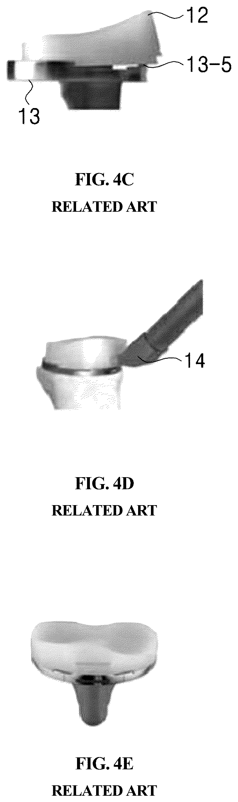 Patent US12569348 Figure 5 – Bearing component for artificial knee joint