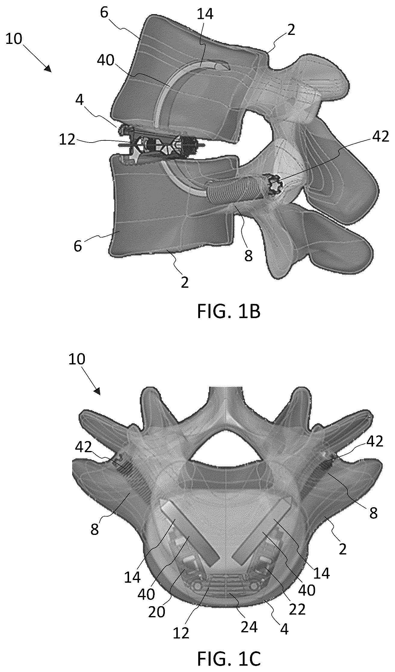 Patent US12569350 Figure 2 – Interlaminar lumbar interbody fusion implants, intradiscal implants, instruments, and methods
