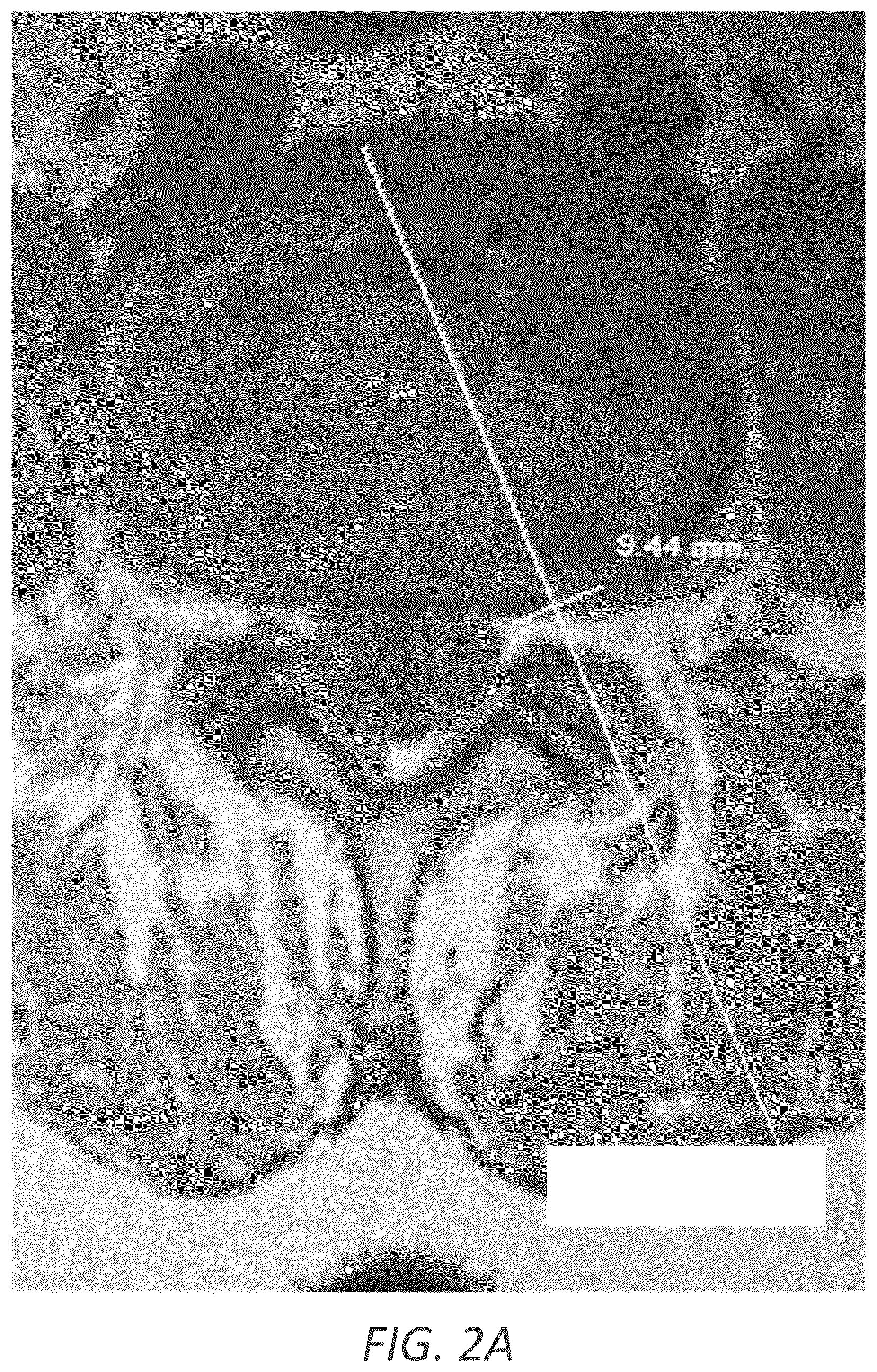 Patent US12569352 Figure 3 – Minimally invasive robotic assisted trans-facet lumbar interbody fusion