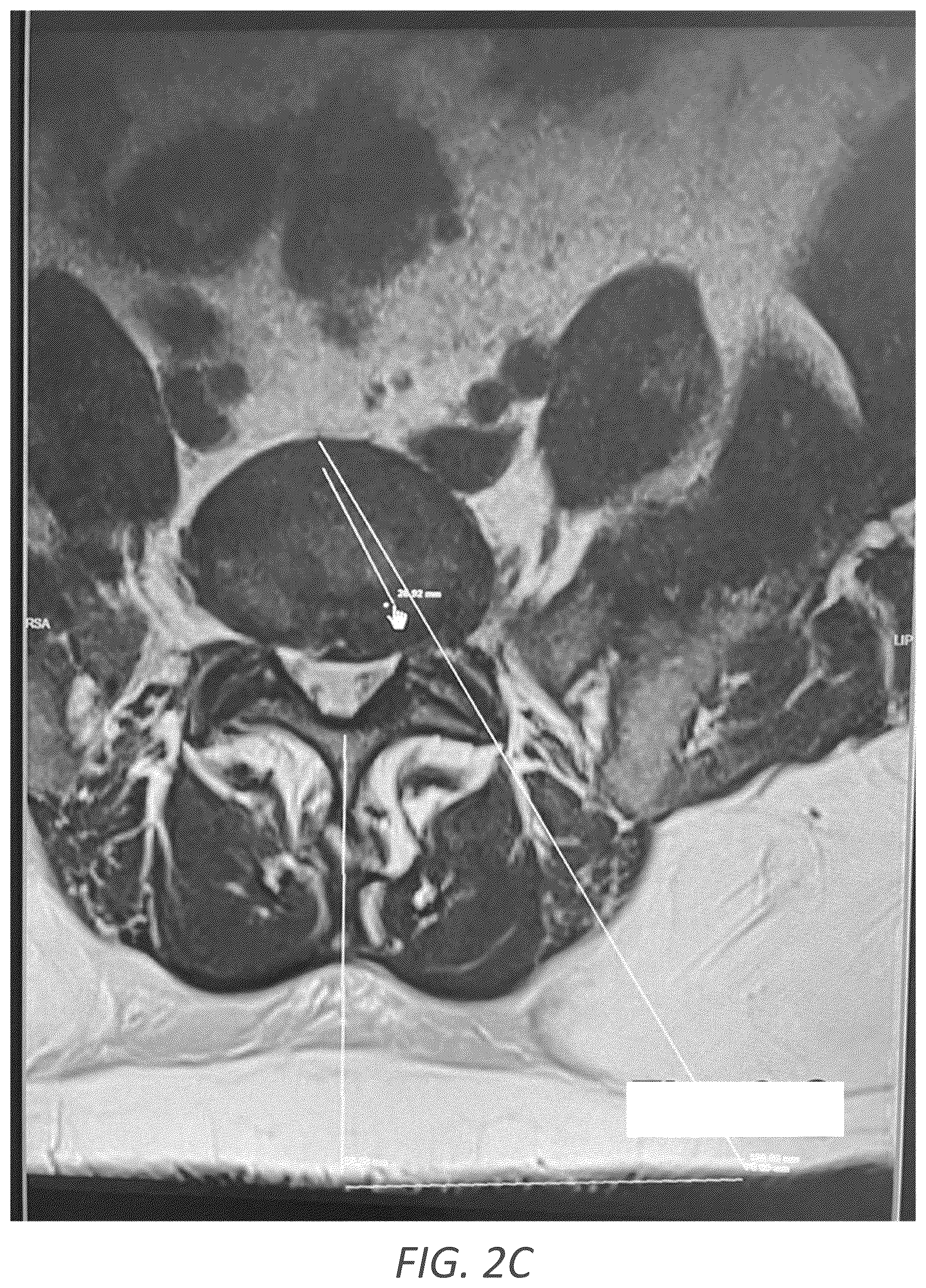 Patent US12569352 Figure 5 – Minimally invasive robotic assisted trans-facet lumbar interbody fusion