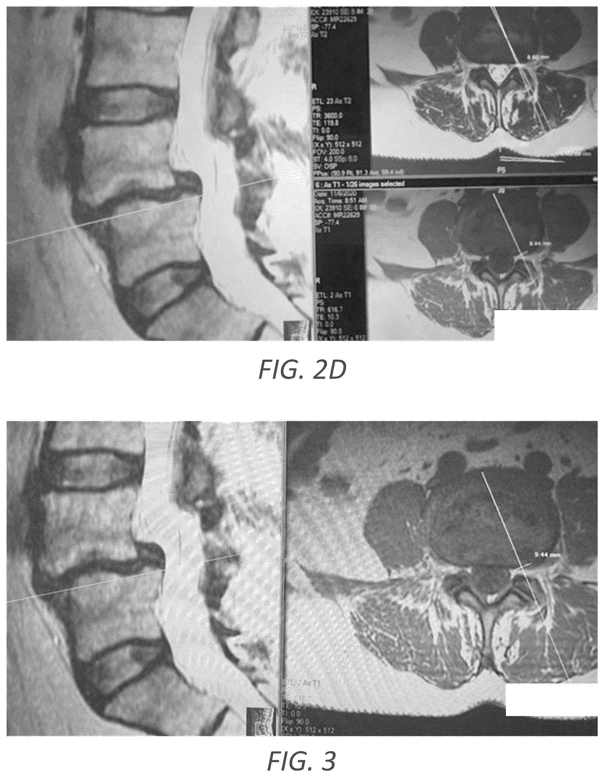 Patent US12569352 Figure 6 – Minimally invasive robotic assisted trans-facet lumbar interbody fusion