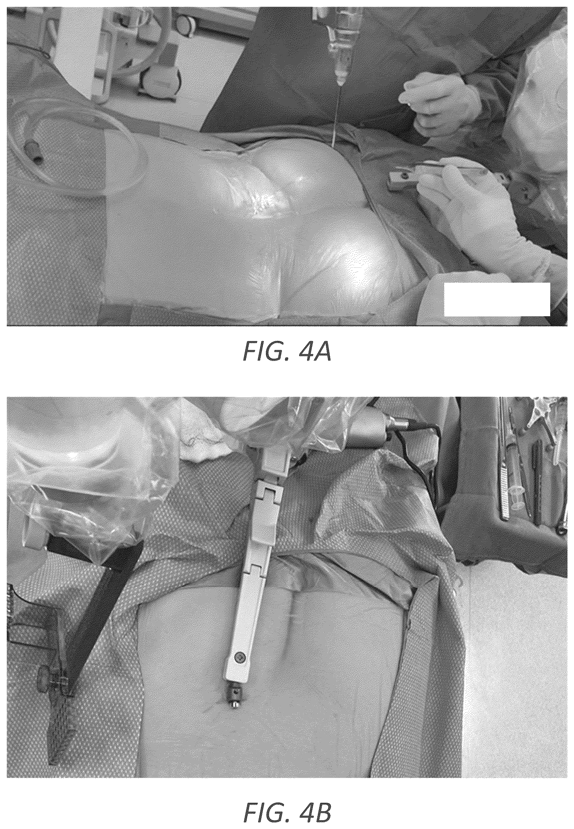 Patent US12569352 Figure 7 – Minimally invasive robotic assisted trans-facet lumbar interbody fusion