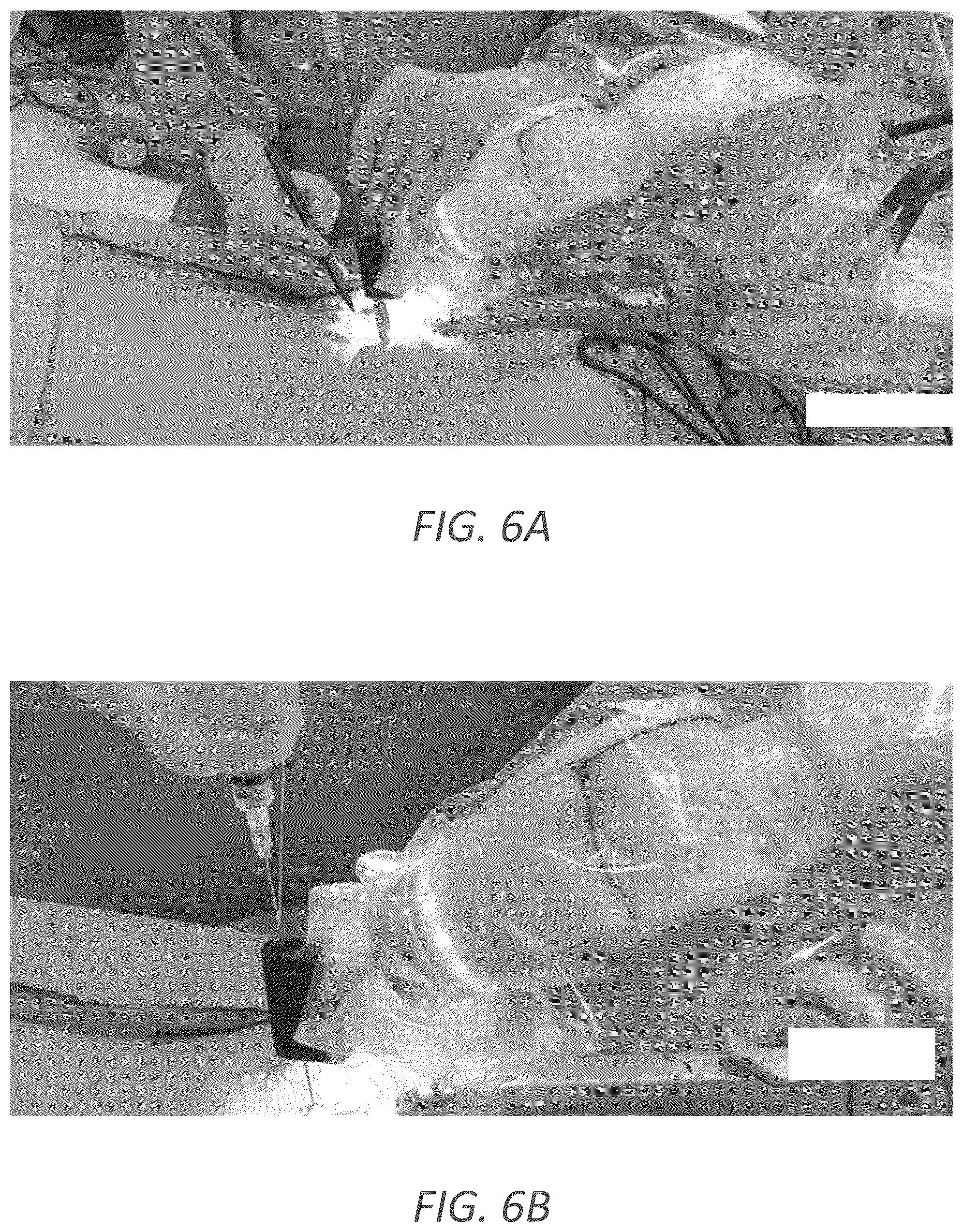Patent US12569352 Figure 9 – Minimally invasive robotic assisted trans-facet lumbar interbody fusion