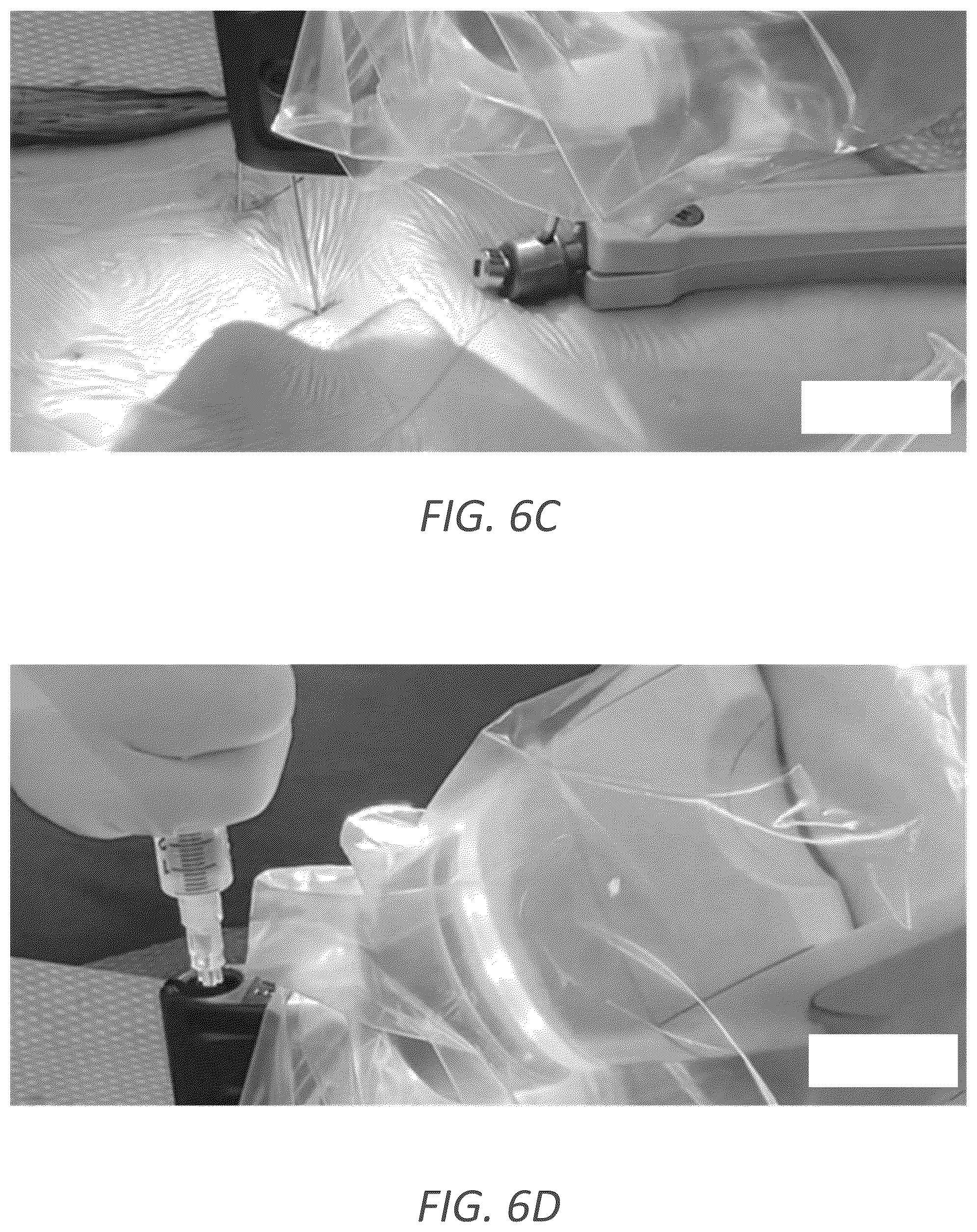 Patent US12569352 Figure 10 – Minimally invasive robotic assisted trans-facet lumbar interbody fusion