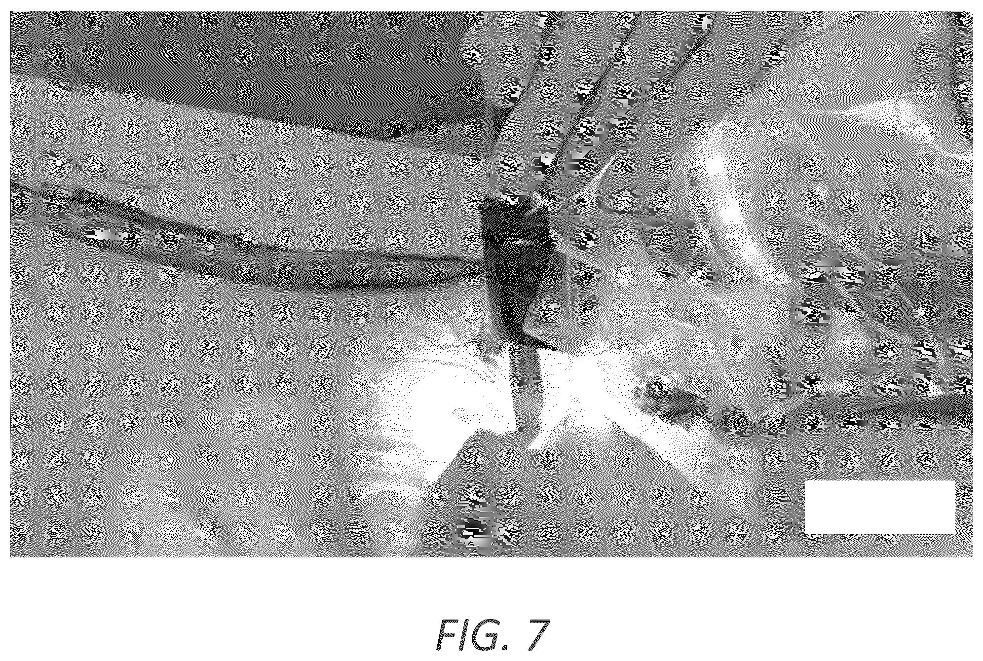 Patent US12569352 Figure 11 – Minimally invasive robotic assisted trans-facet lumbar interbody fusion