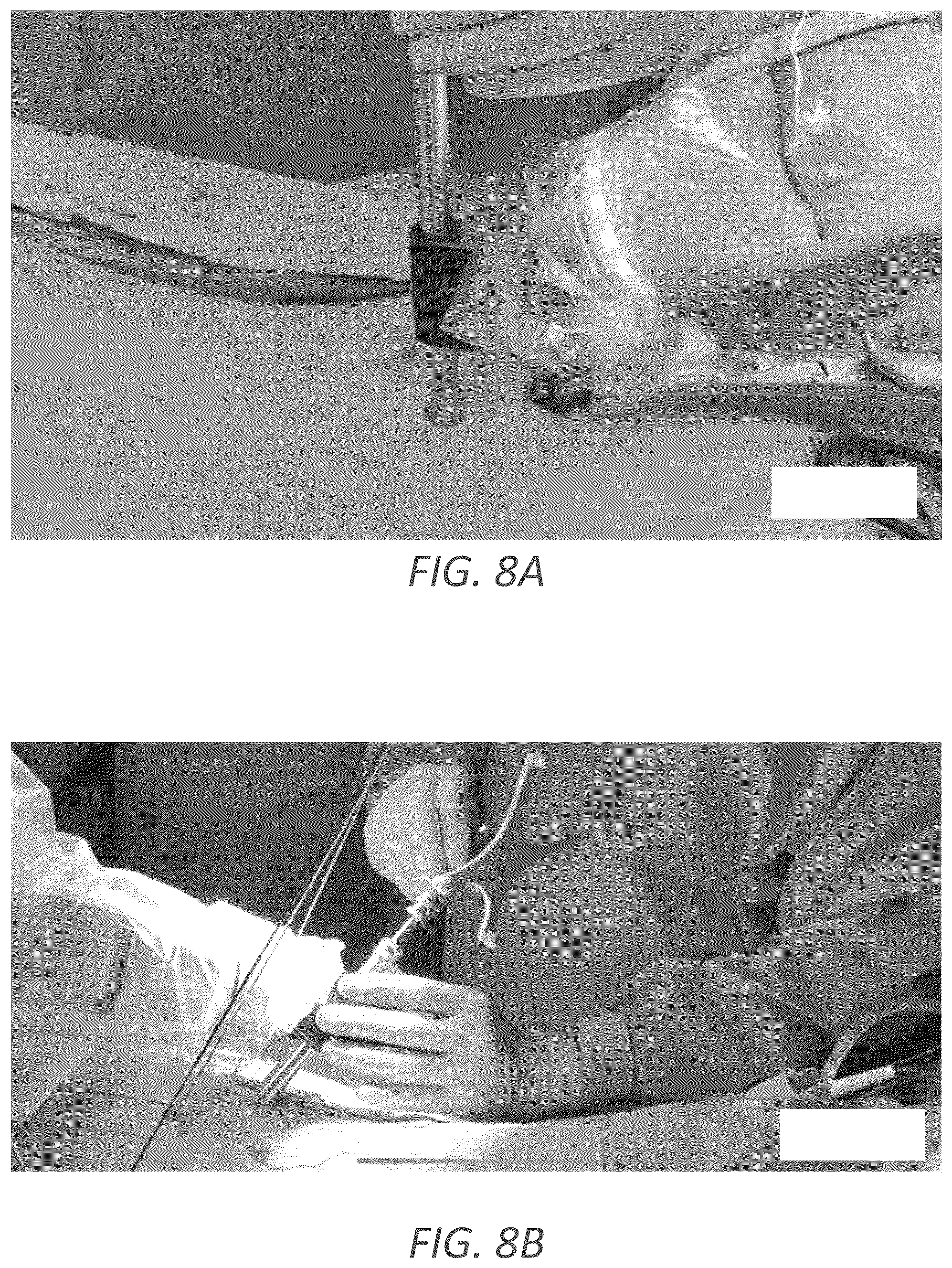 Patent US12569352 Figure 12 – Minimally invasive robotic assisted trans-facet lumbar interbody fusion