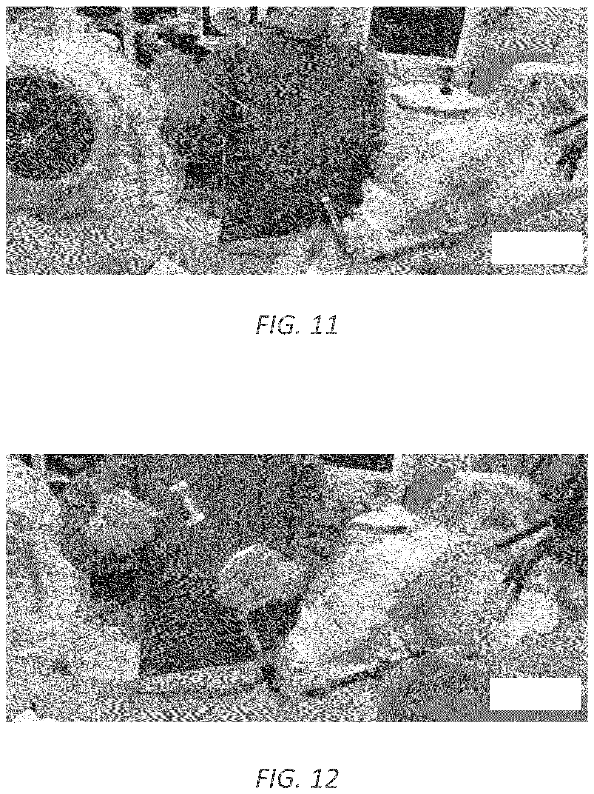 Patent US12569352 Figure 14 – Minimally invasive robotic assisted trans-facet lumbar interbody fusion