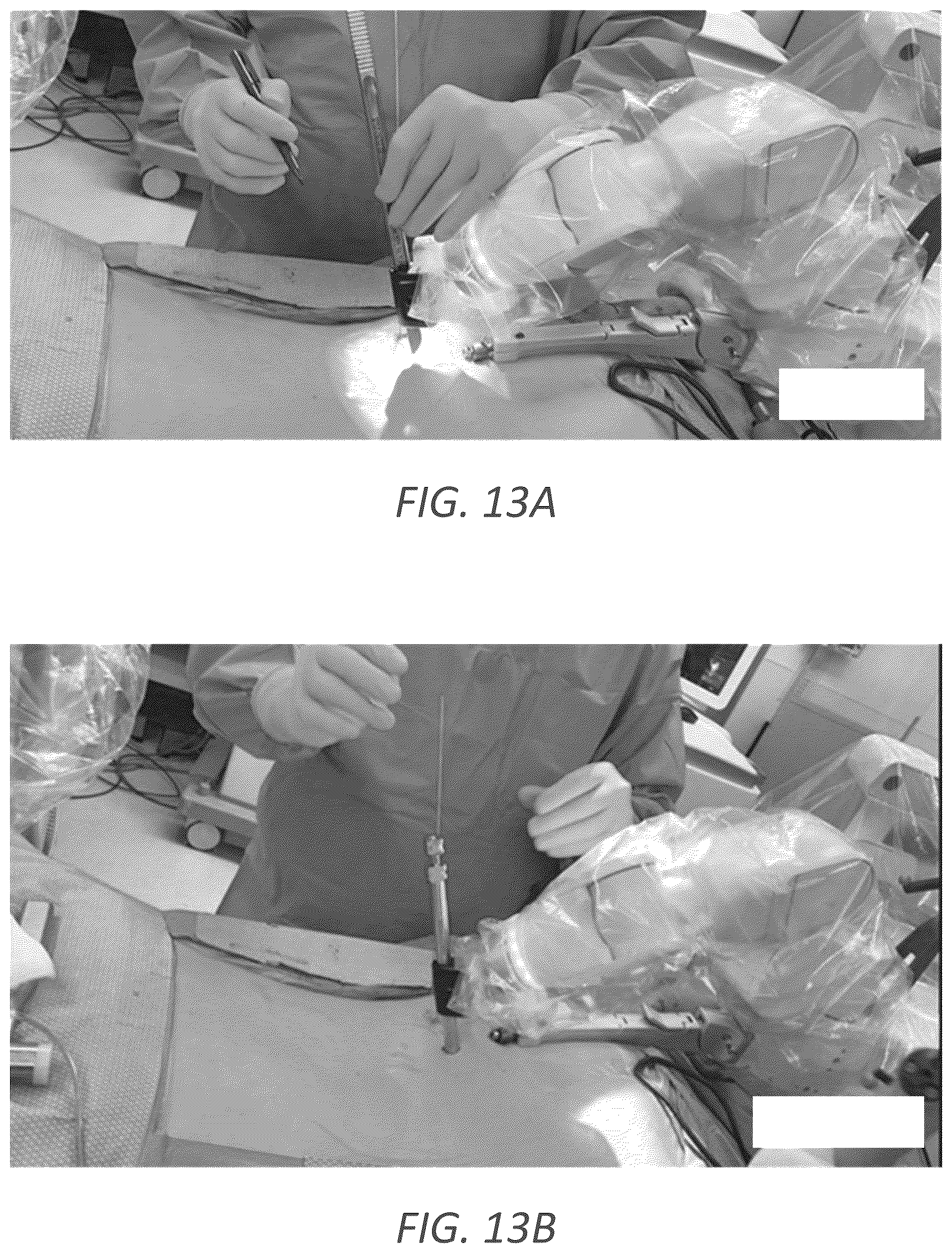 Patent US12569352 Figure 15 – Minimally invasive robotic assisted trans-facet lumbar interbody fusion